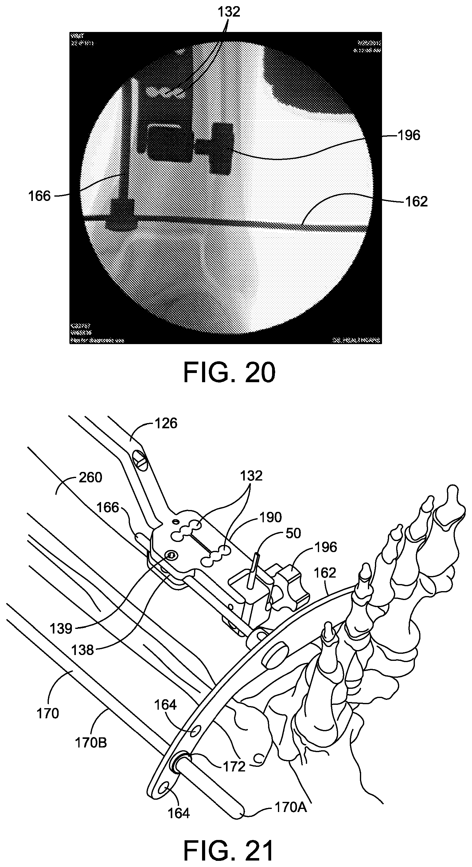 Patent US12096948 Figure 17 – Ankle replacement system and method