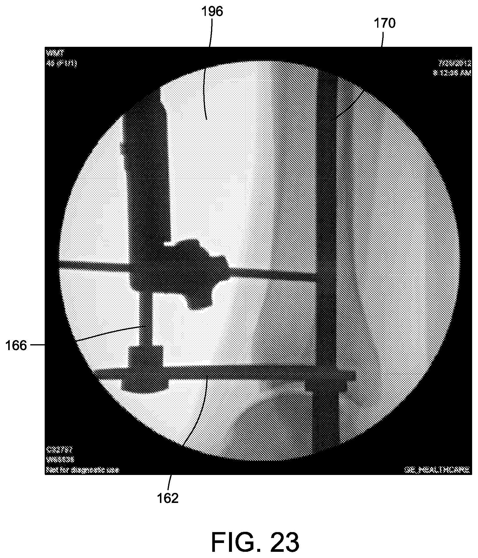 Patent US12096948 Figure 19 – Ankle replacement system and method