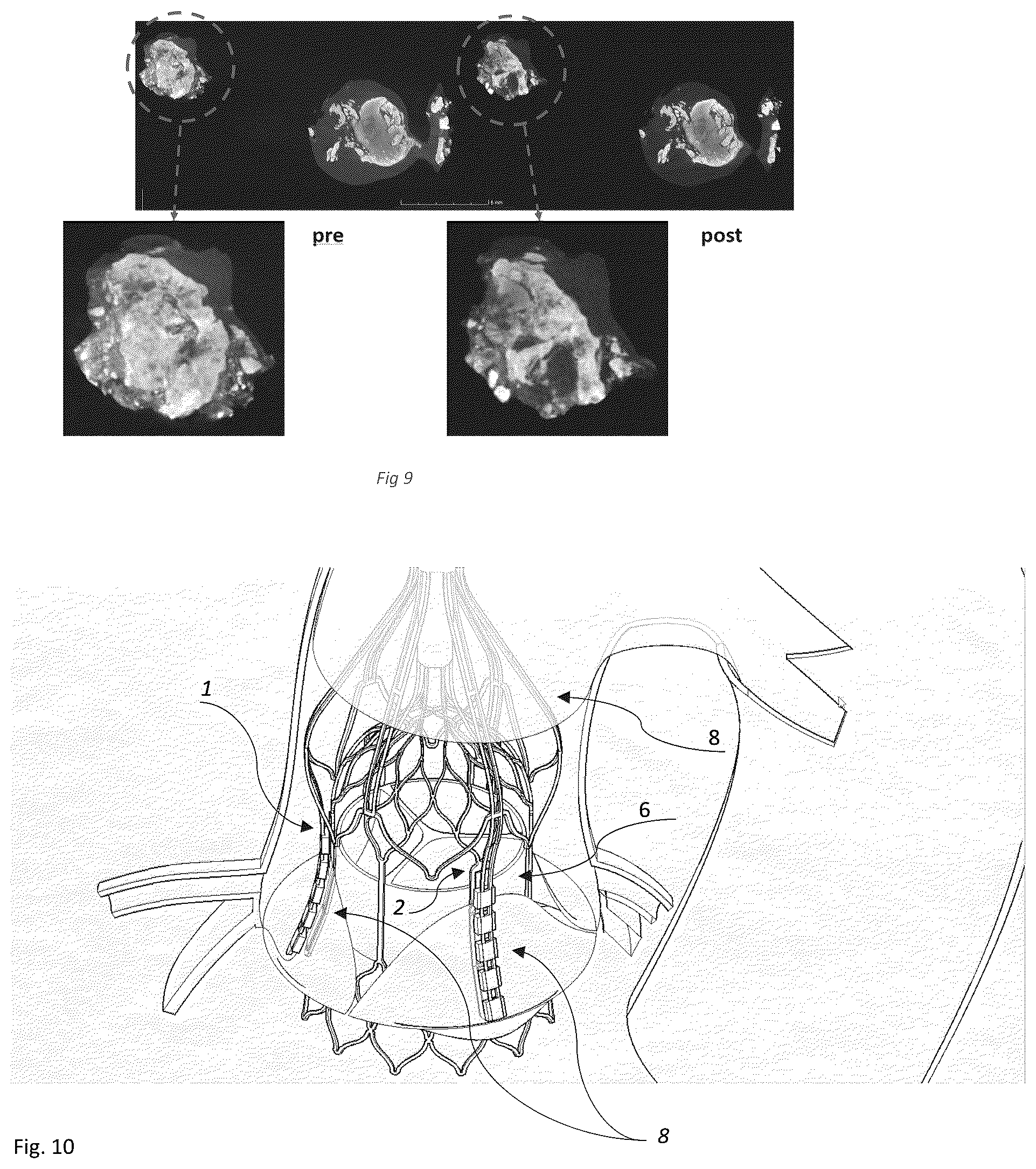 Patent US12096949 Figure 3 – Device for the treatment of tissue calcification
