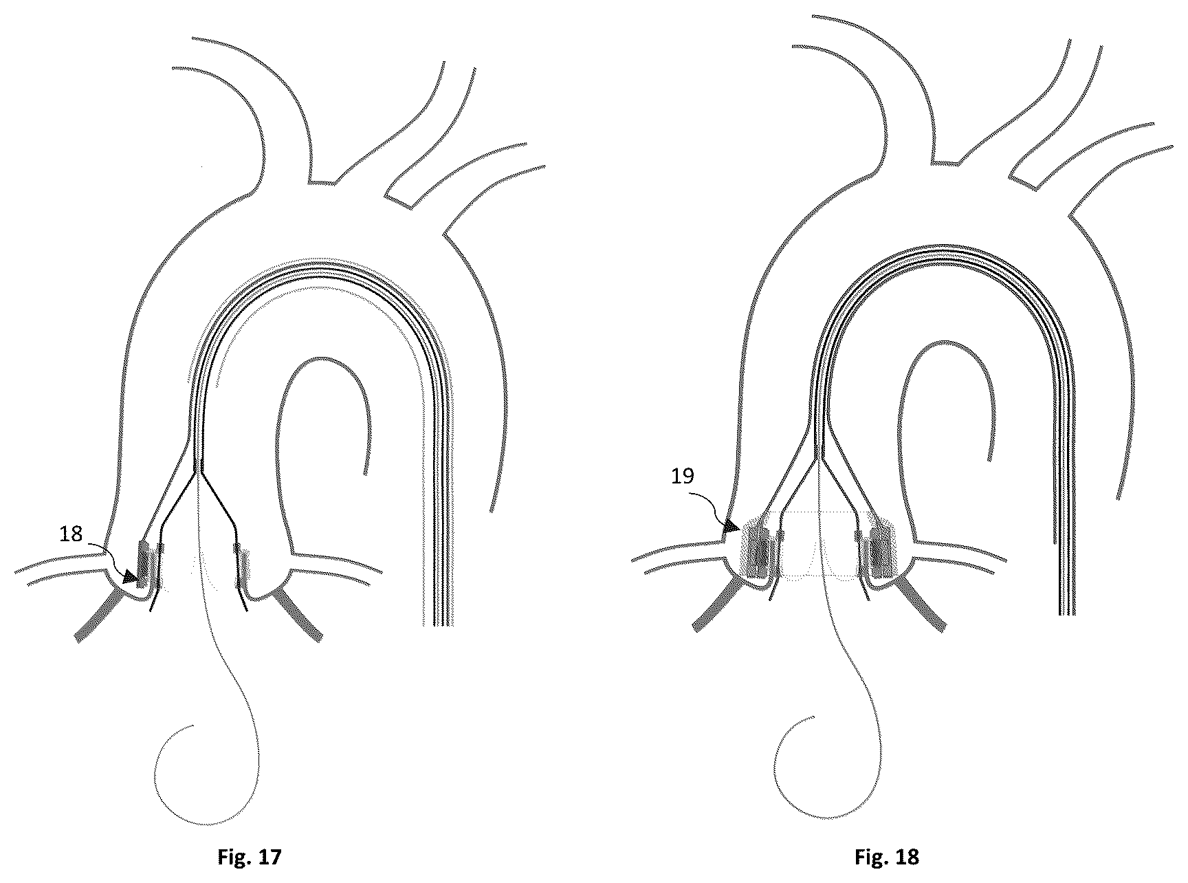 Patent US12096949 Figure 6 – Device for the treatment of tissue calcification