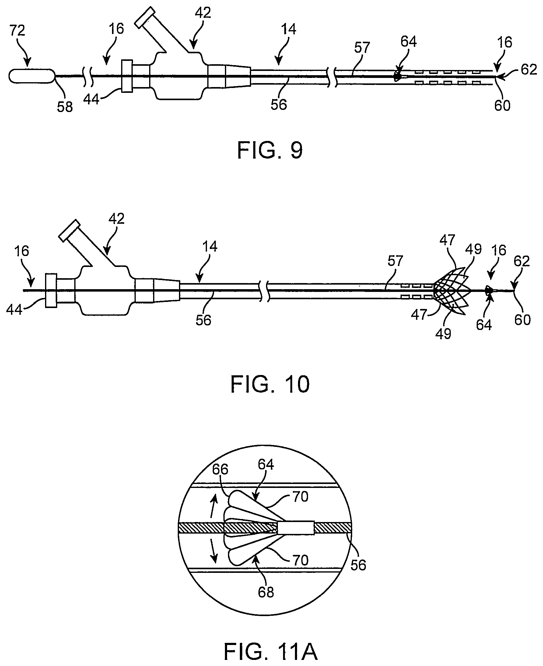 Patent US12096951 Figure 11 – System and method for treating ischemic stroke