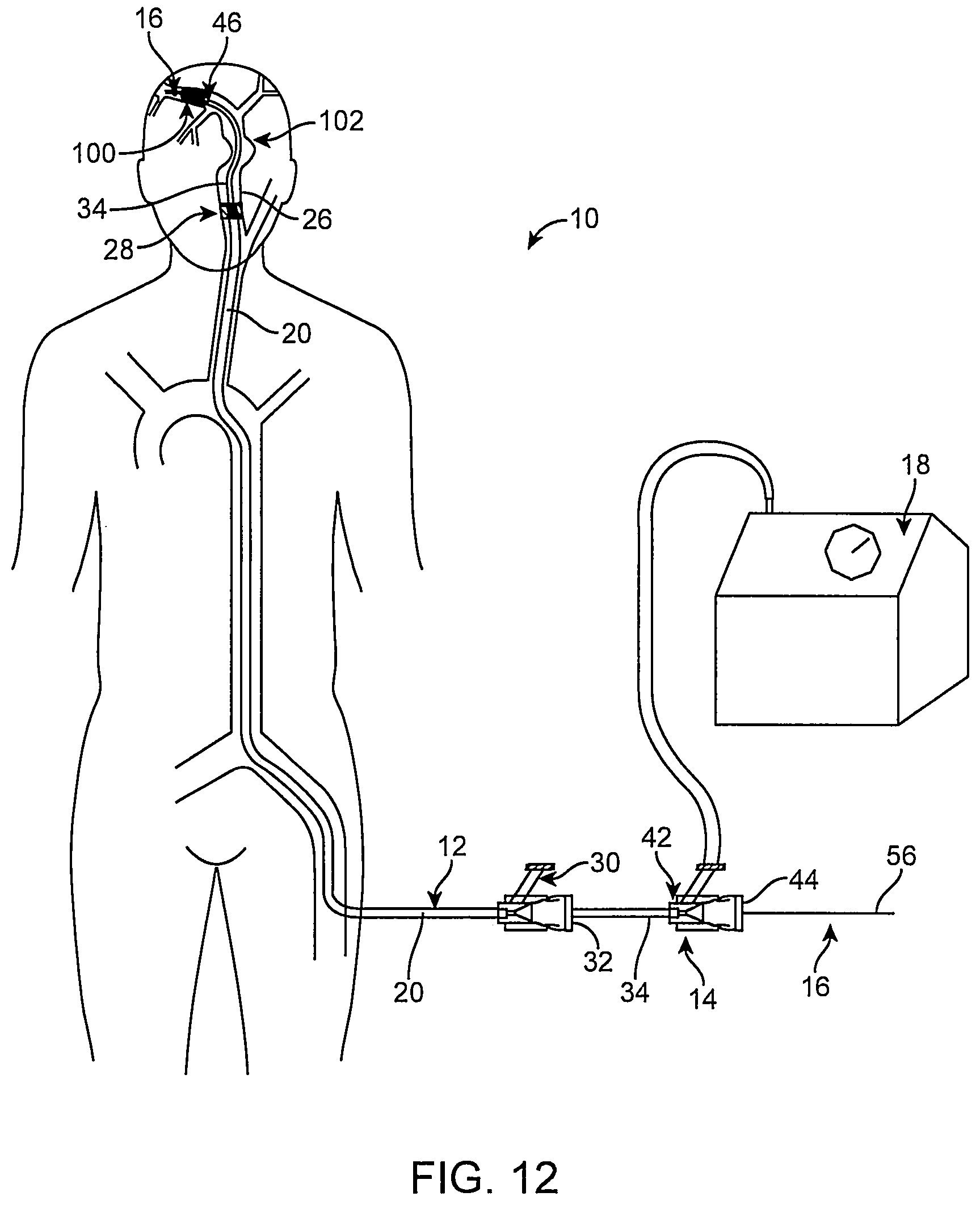 Patent US12096951 Figure 13 – System and method for treating ischemic stroke