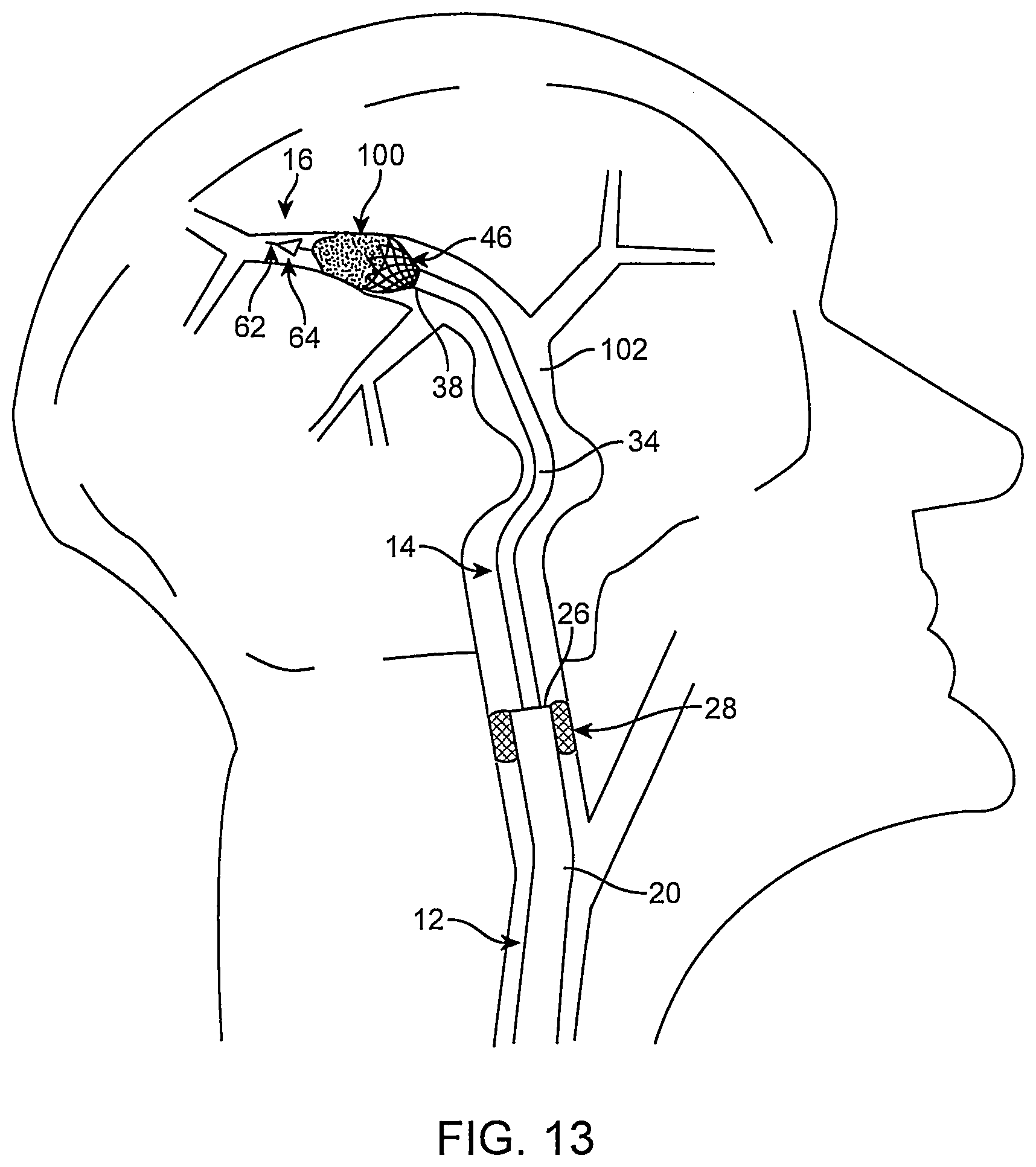 Patent US12096951 Figure 14 – System and method for treating ischemic stroke