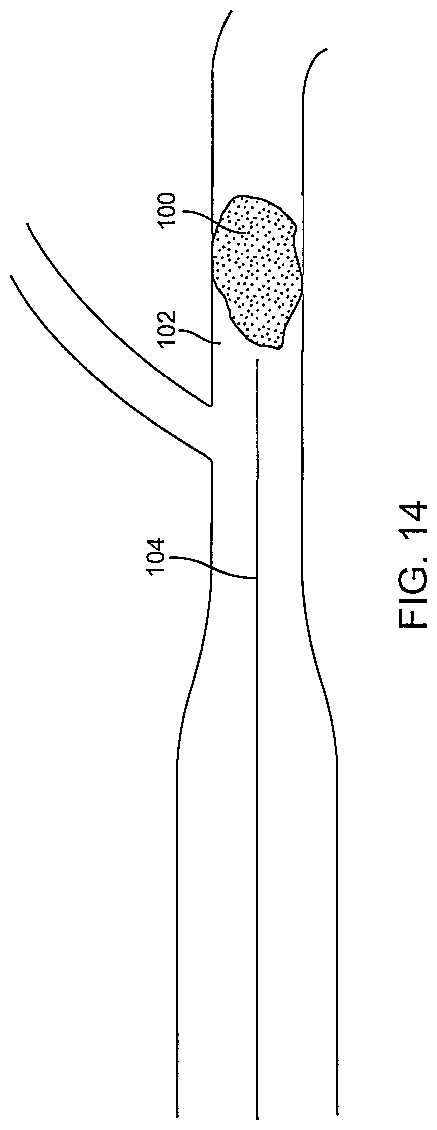 Patent US12096951 Figure 15 – System and method for treating ischemic stroke