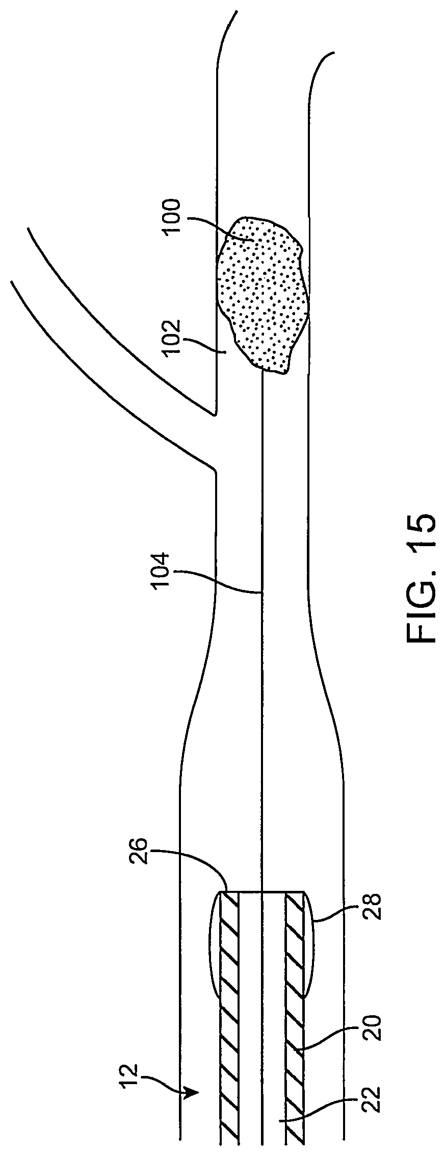 Patent US12096951 Figure 16 – System and method for treating ischemic stroke