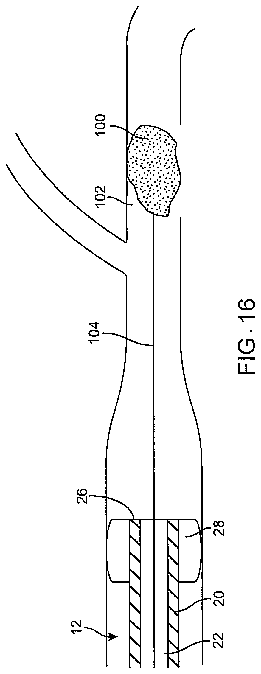 Patent US12096951 Figure 17 – System and method for treating ischemic stroke
