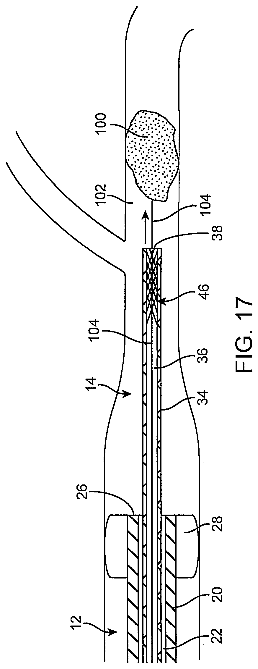 Patent US12096951 Figure 18 – System and method for treating ischemic stroke