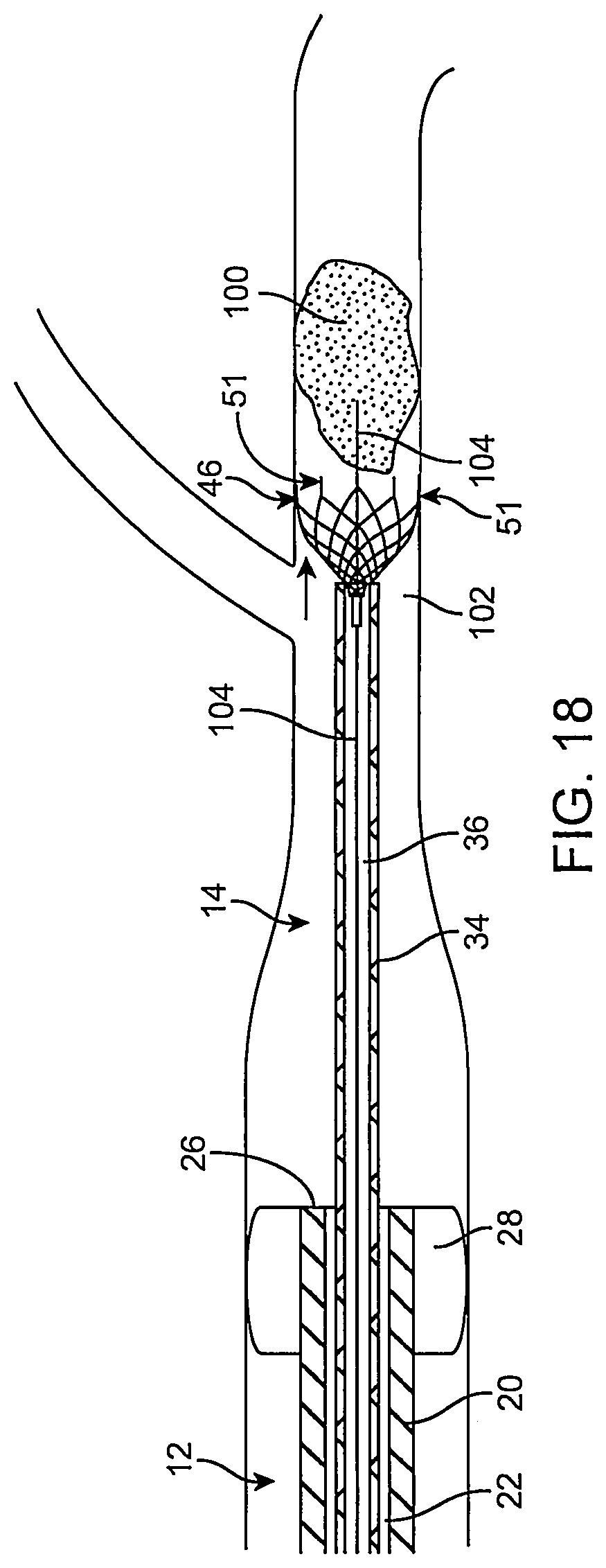 Patent US12096951 Figure 19 – System and method for treating ischemic stroke
