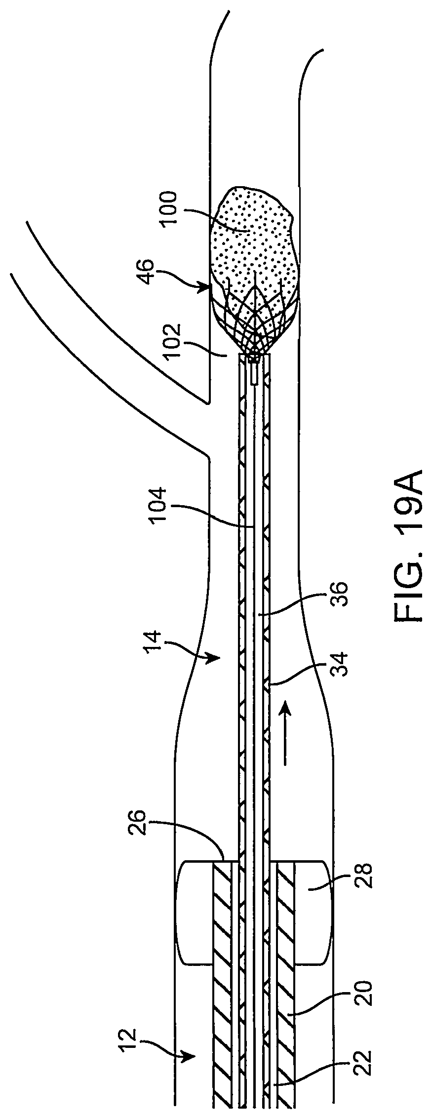 Patent US12096951 Figure 20 – System and method for treating ischemic stroke