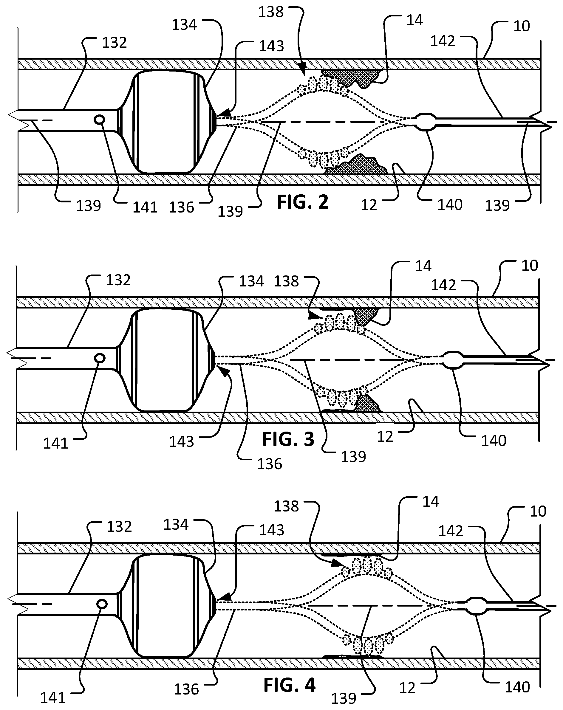 Patent US12096956 Figure 2 – Atherectomy devices and methods