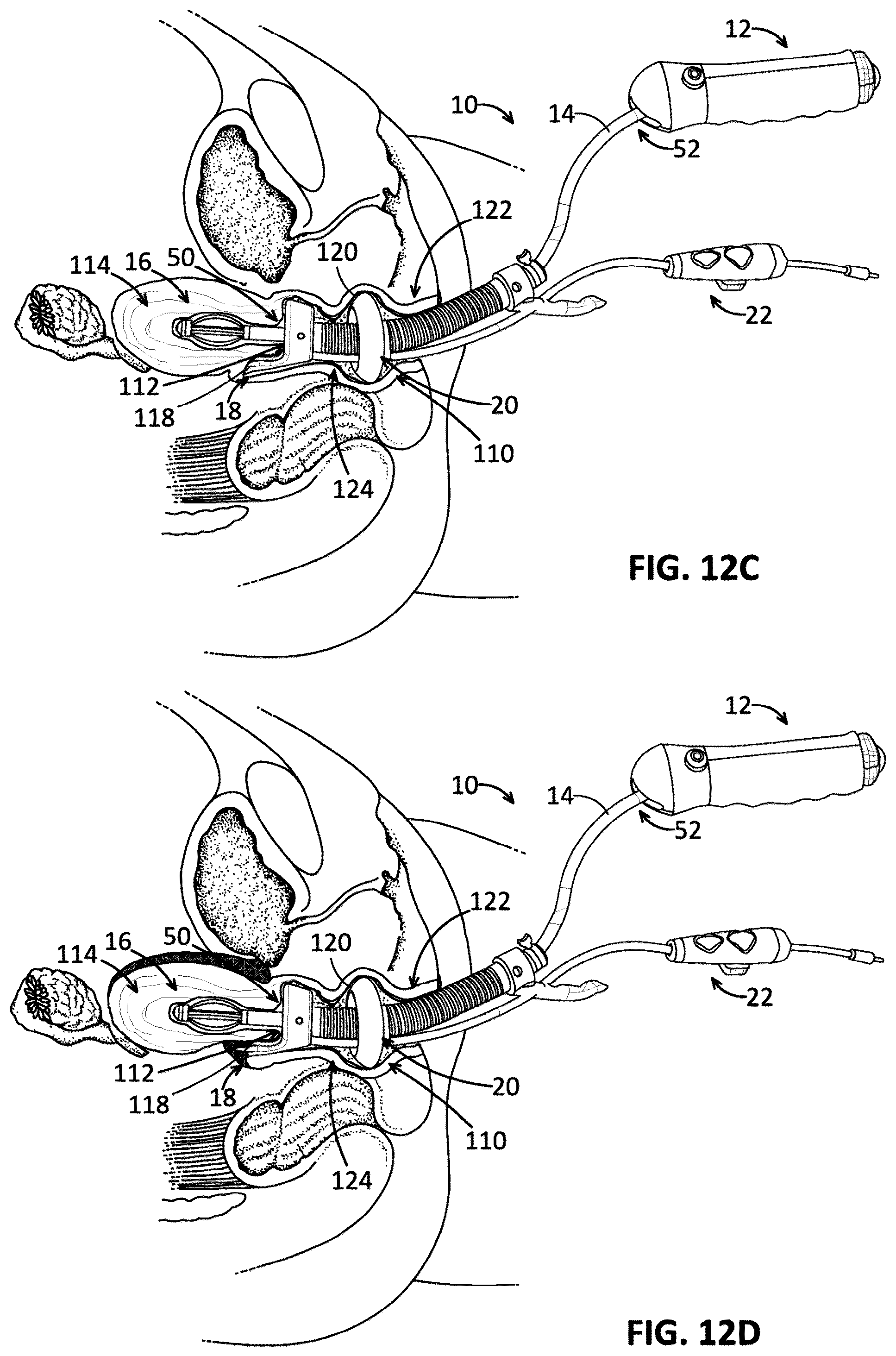 Patent US12096960 Figure 10 – Uterine manipulator