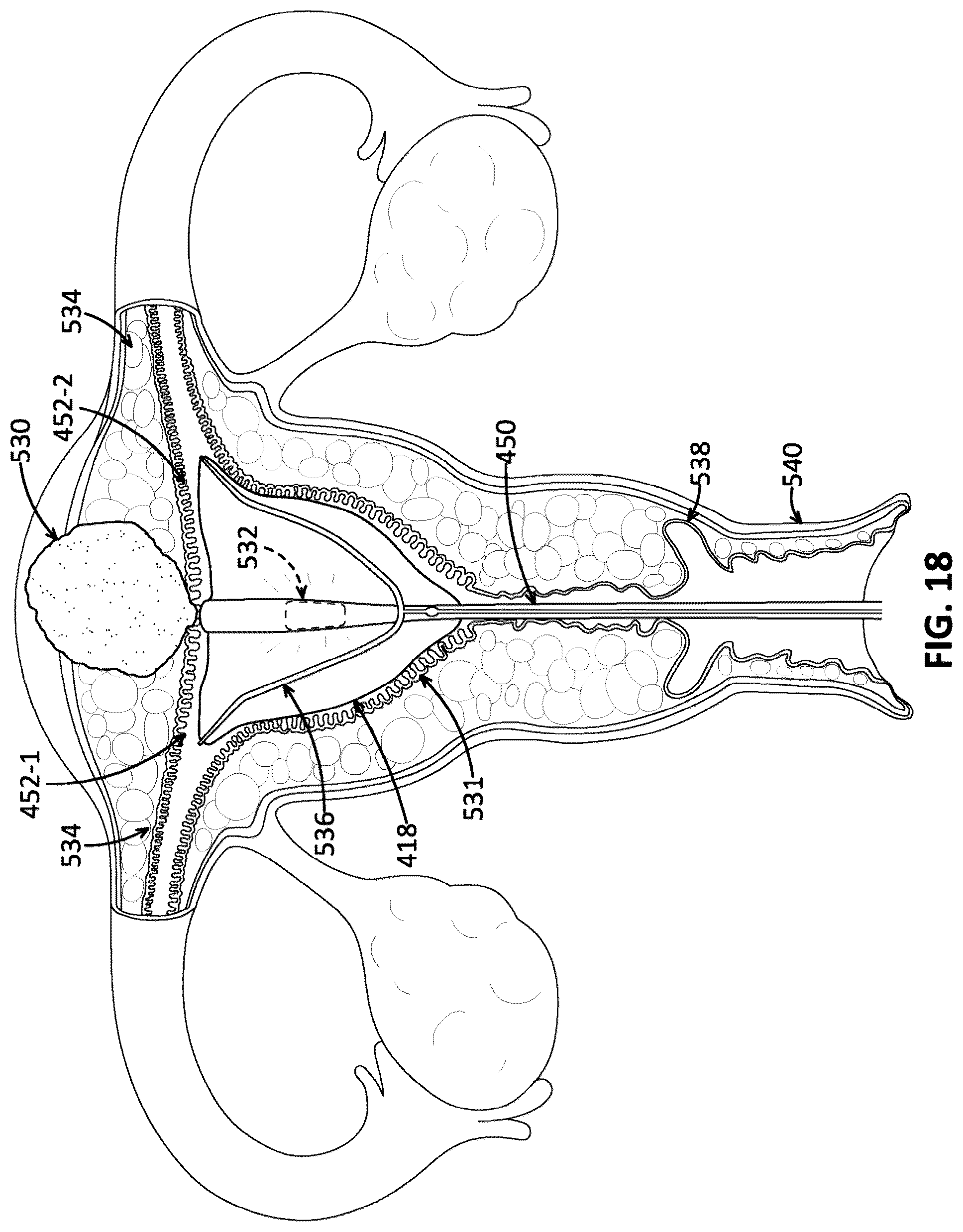 Patent US12096960 Figure 16 – Uterine manipulator