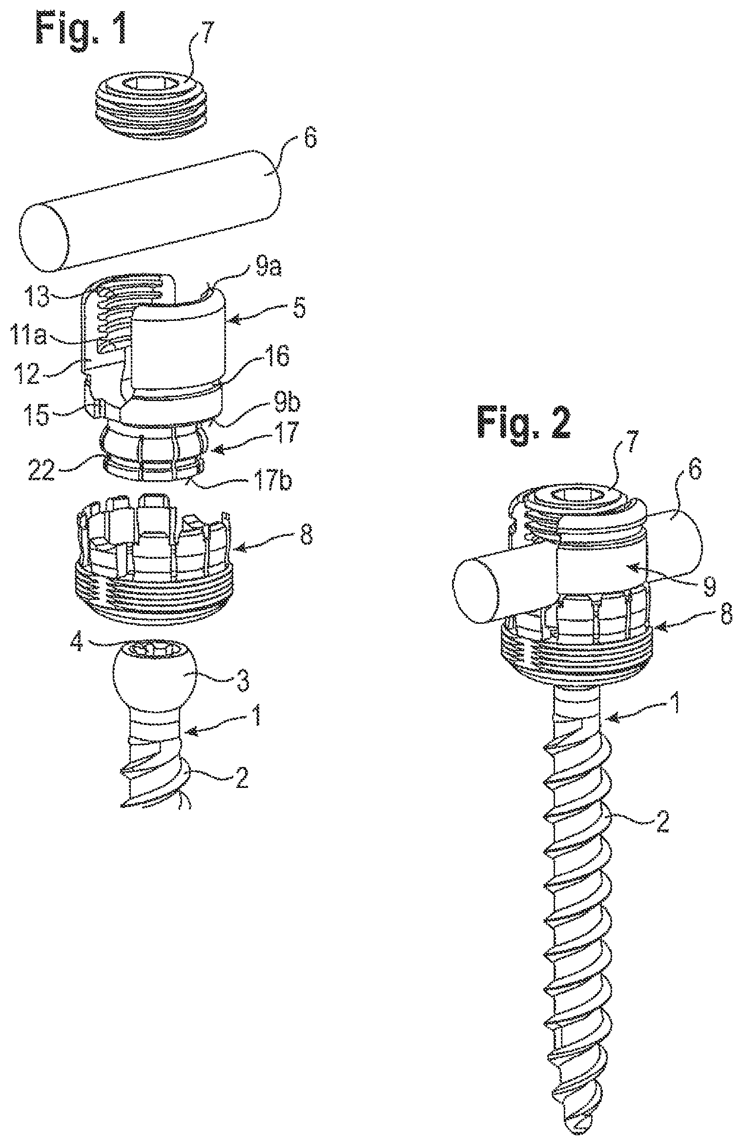 Patent US12096962 Figure 1 – Bone anchoring device and tool cooperating with such a bone anchoring device