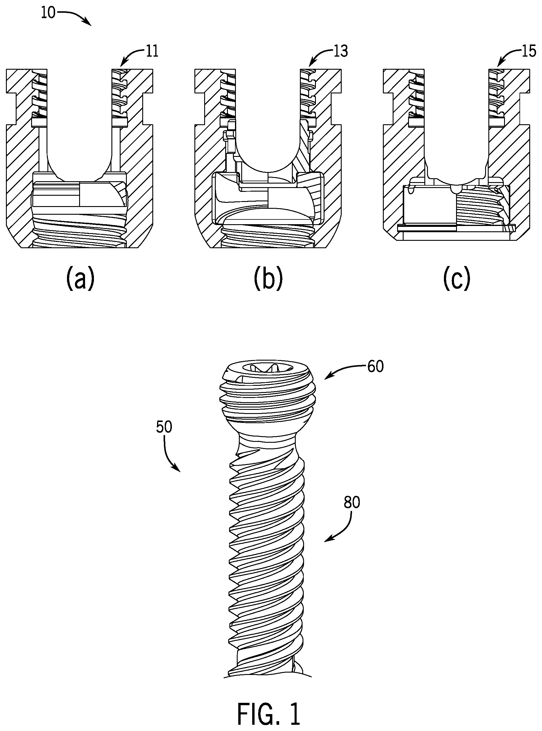 Patent US12096964 Figure 1 – Modular bone anchor system with bottom loaded shank heads having a single shank head shape