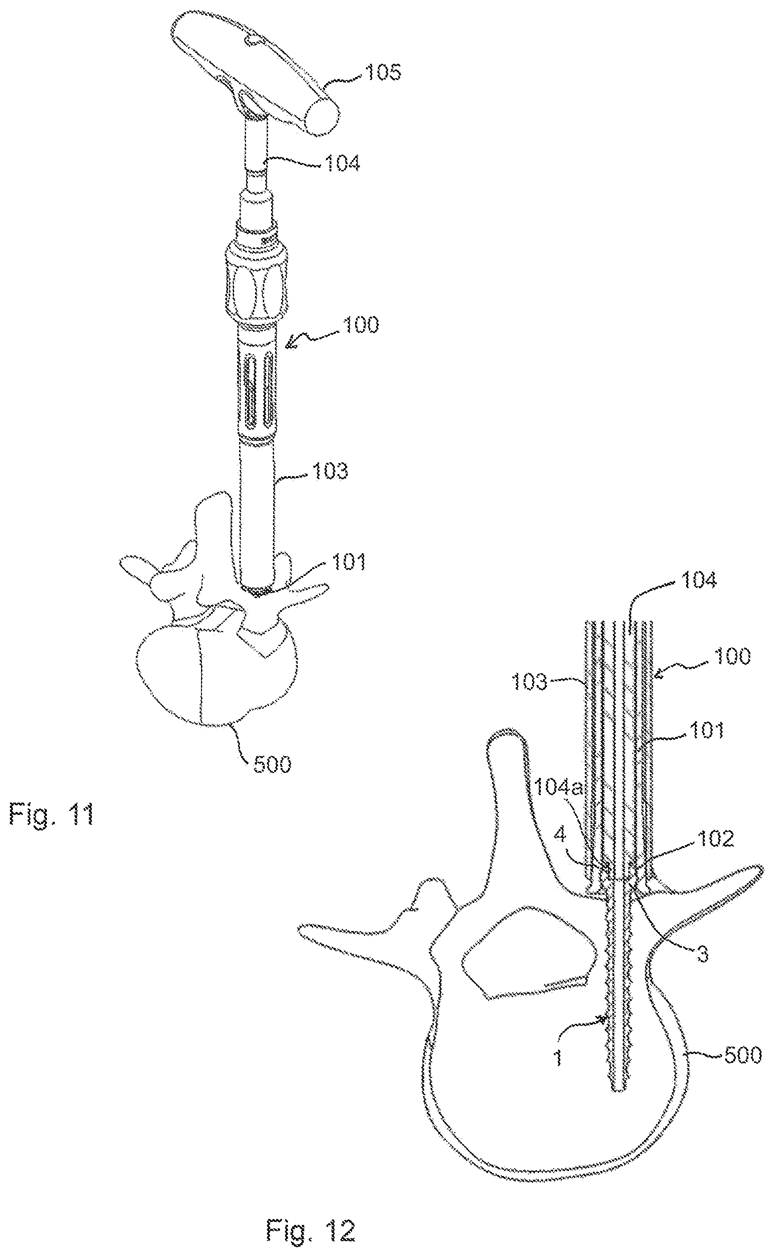 Patent US12096966 Figure 5 – Bone anchor