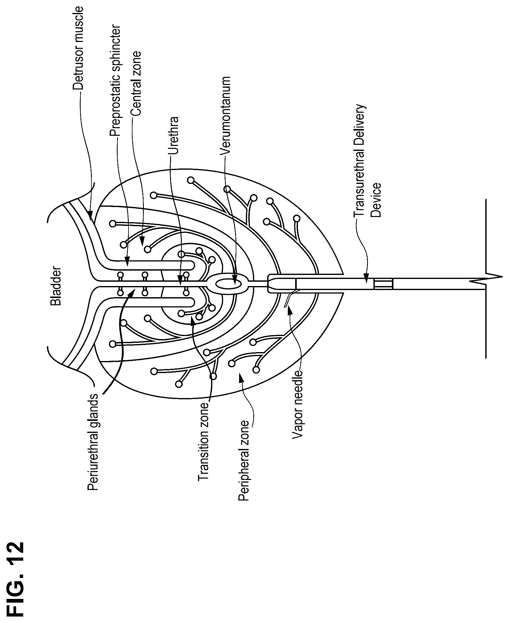 Patent US12096967 Figure 14 – Vapor ablation systems and methods