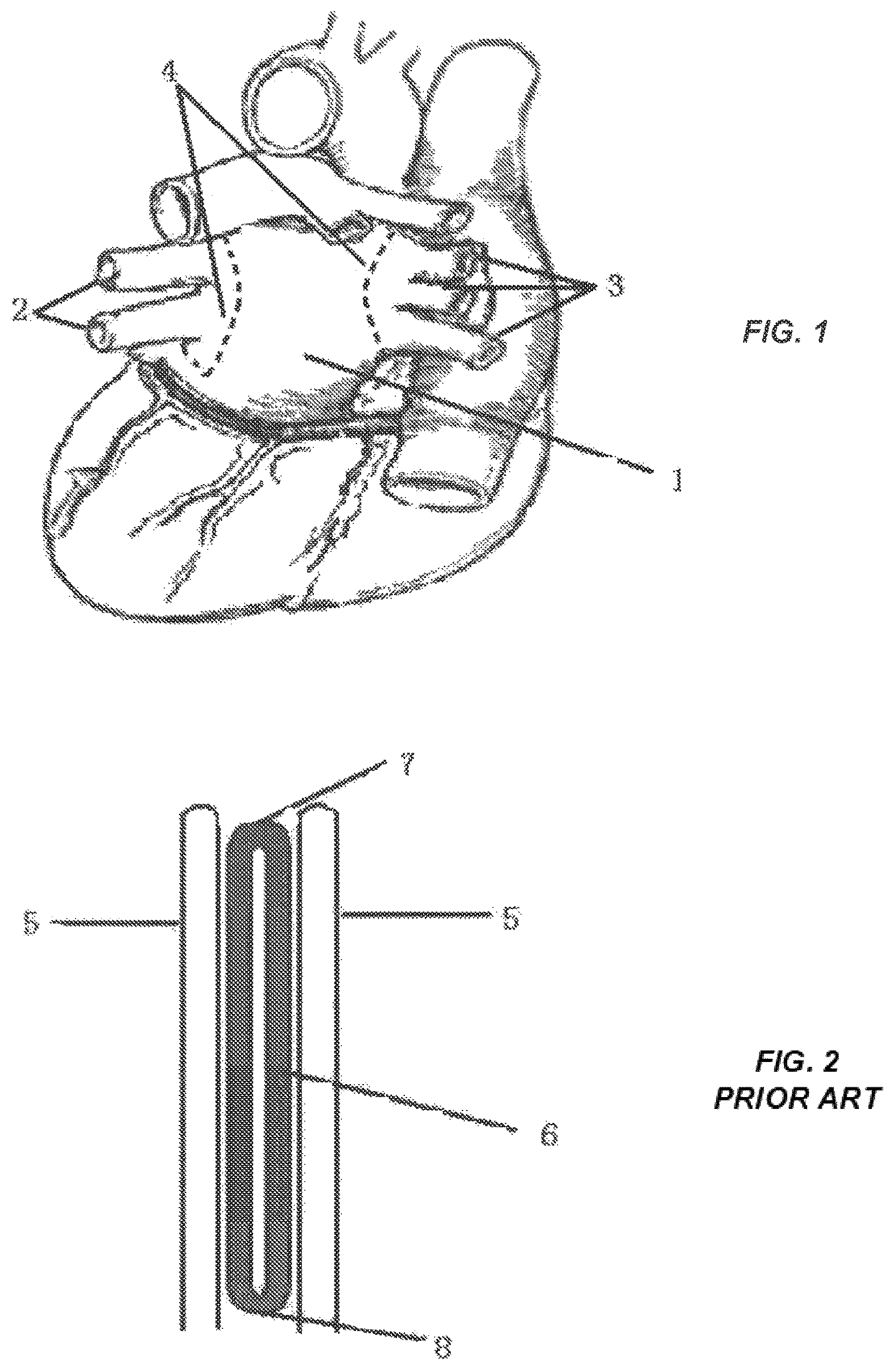 Patent US12096968 Figure 1 – Chemical ablation apparatus for treating arrhythmia