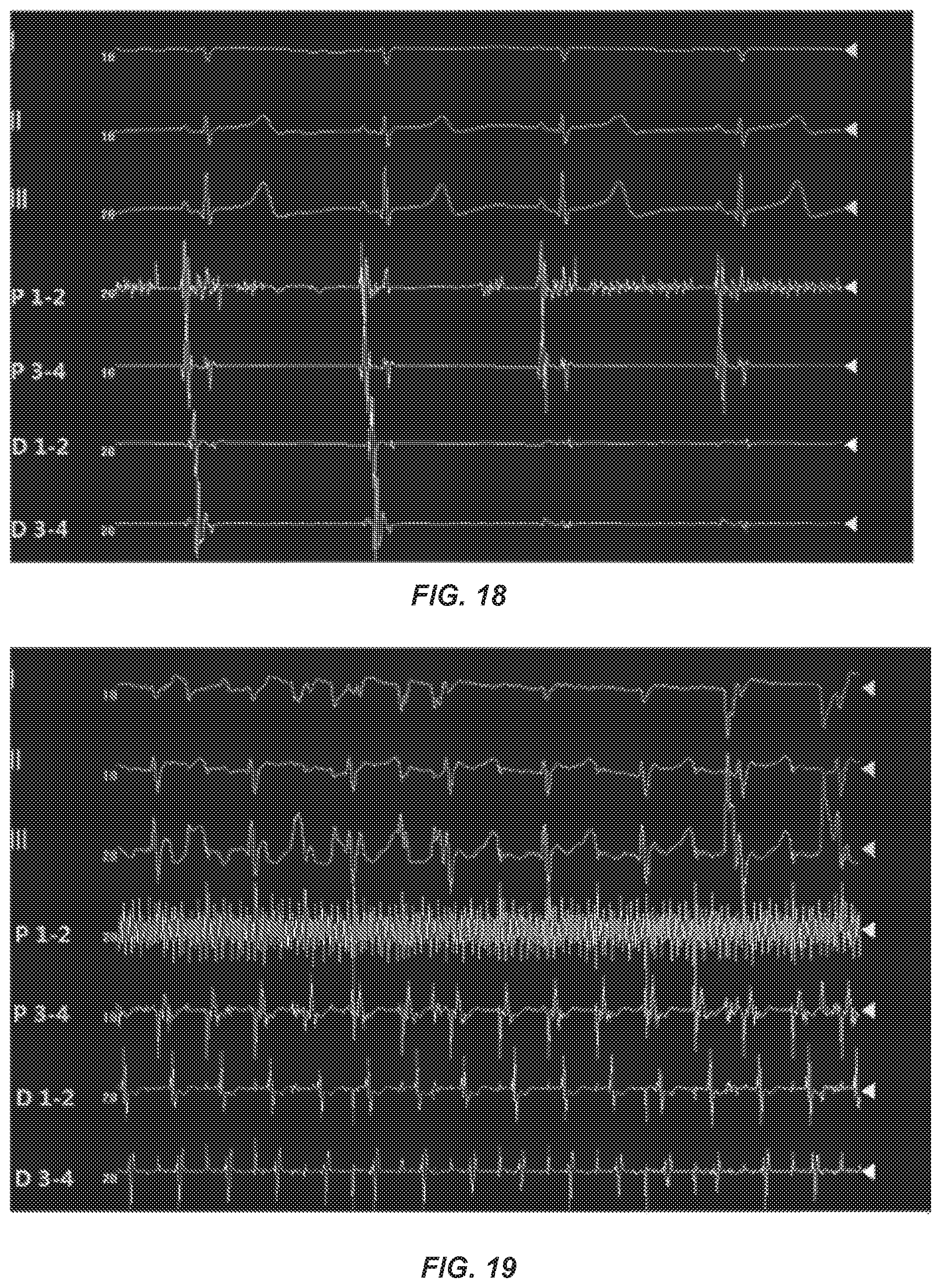 Patent US12096968 Figure 10 – Chemical ablation apparatus for treating arrhythmia
