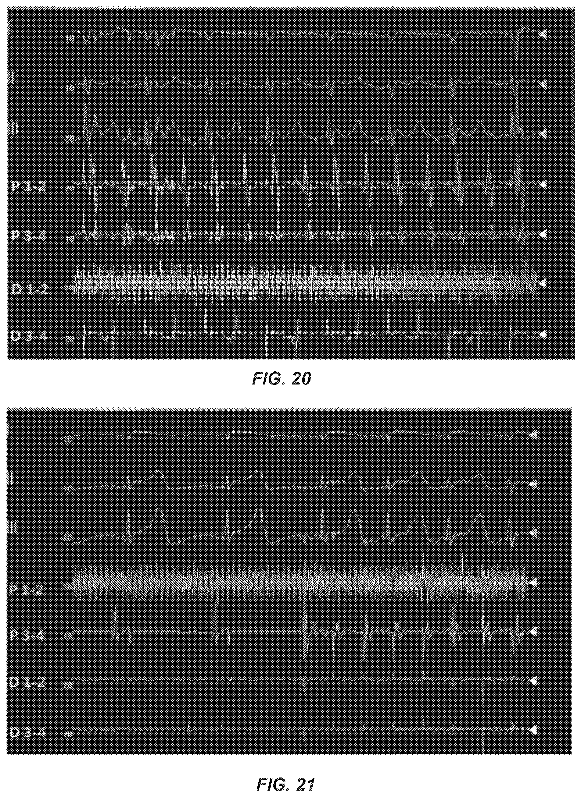 Patent US12096968 Figure 11 – Chemical ablation apparatus for treating arrhythmia