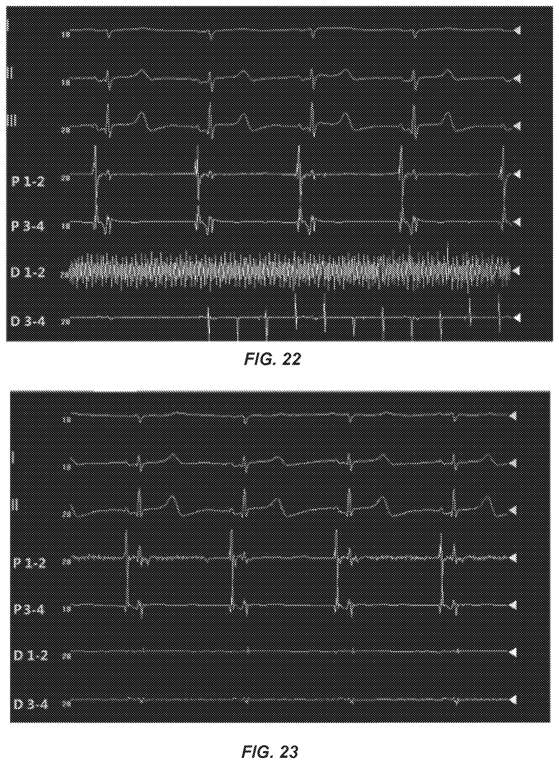 Patent US12096968 Figure 12 – Chemical ablation apparatus for treating arrhythmia