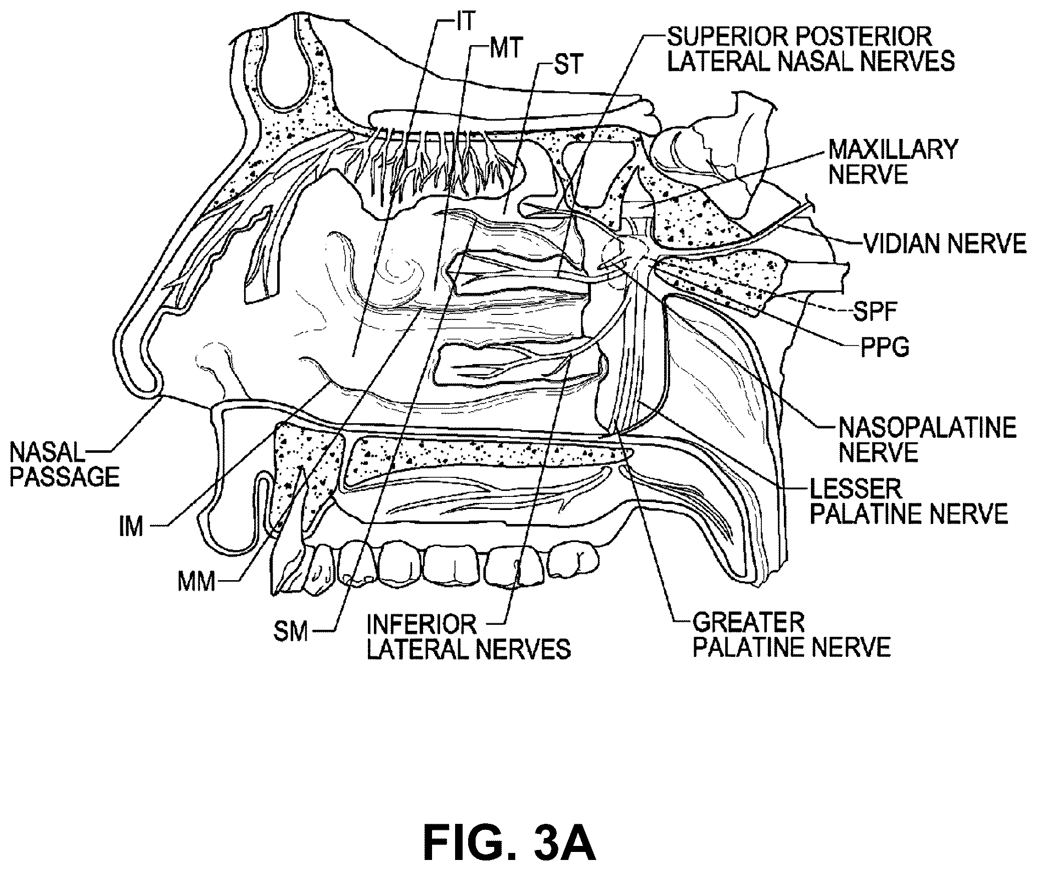 Patent US12096973 Figure 3 – Systems and methods for therapeutic nasal treatment using handheld device