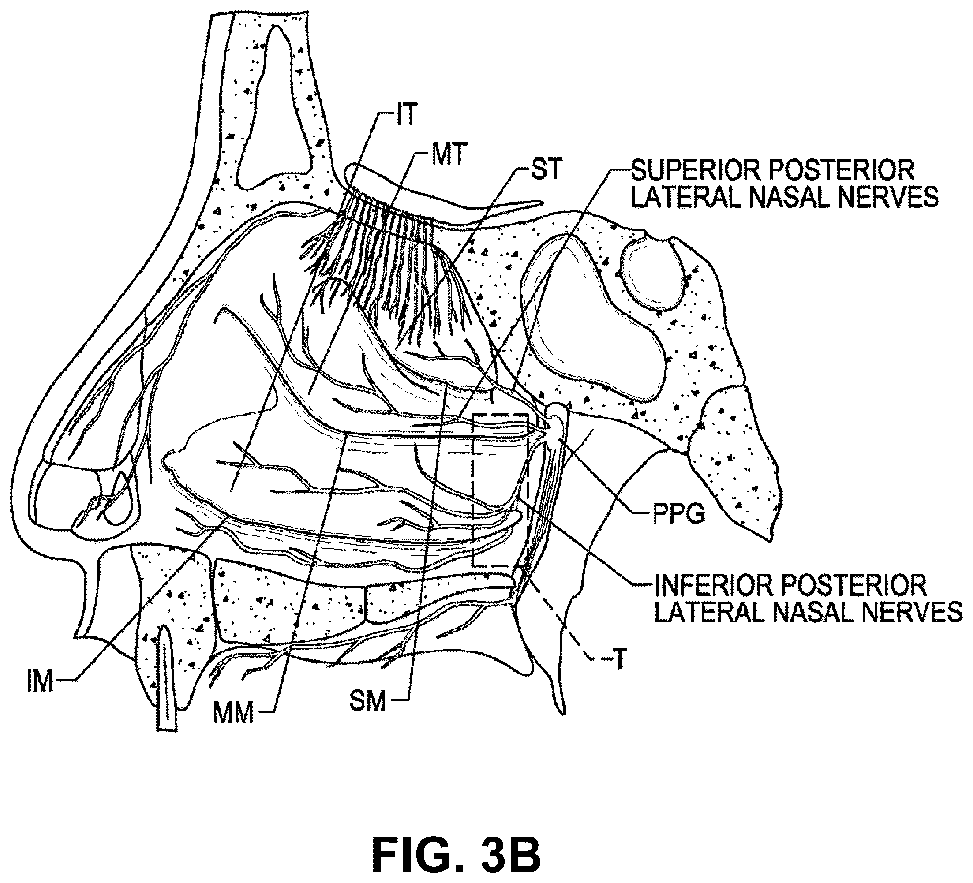 Patent US12096973 Figure 4 – Systems and methods for therapeutic nasal treatment using handheld device