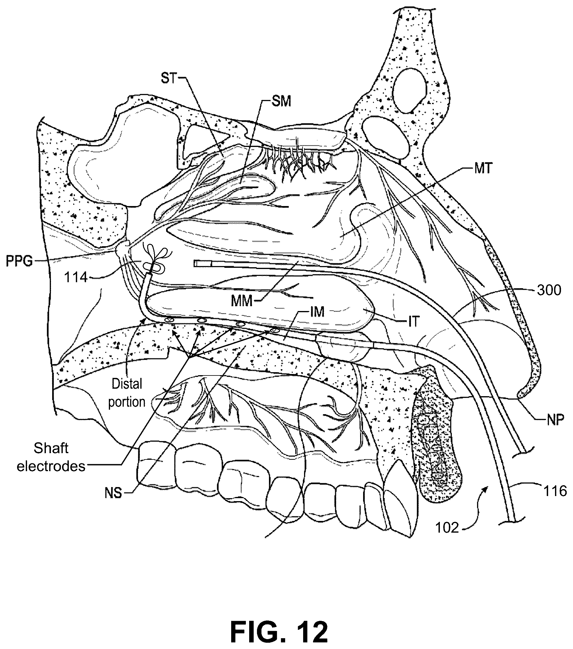 Patent US12096973 Figure 18 – Systems and methods for therapeutic nasal treatment using handheld device