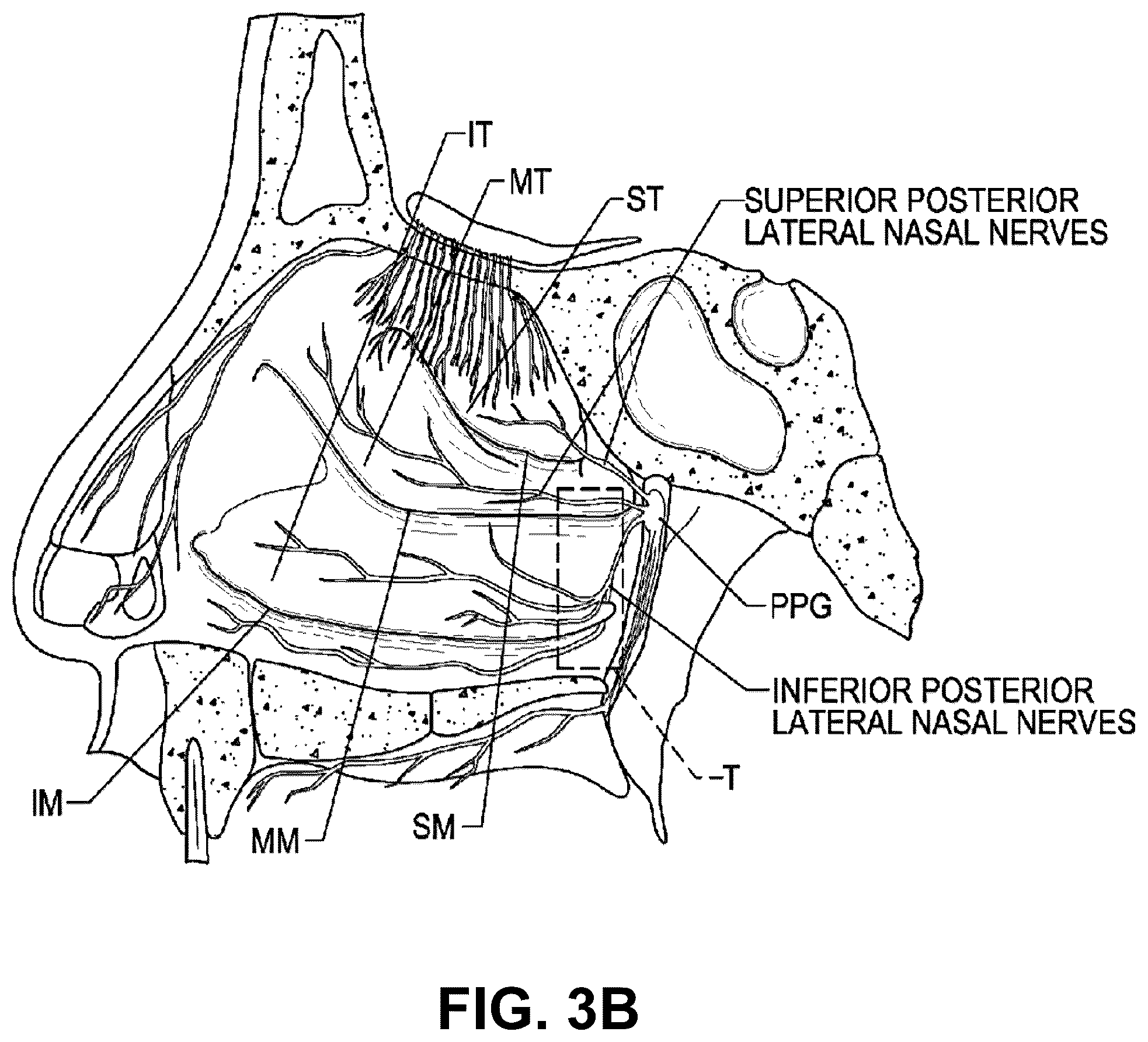 Patent US12096974 Figure 4 – Systems and methods for therapeutic nasal treatment using handheld device