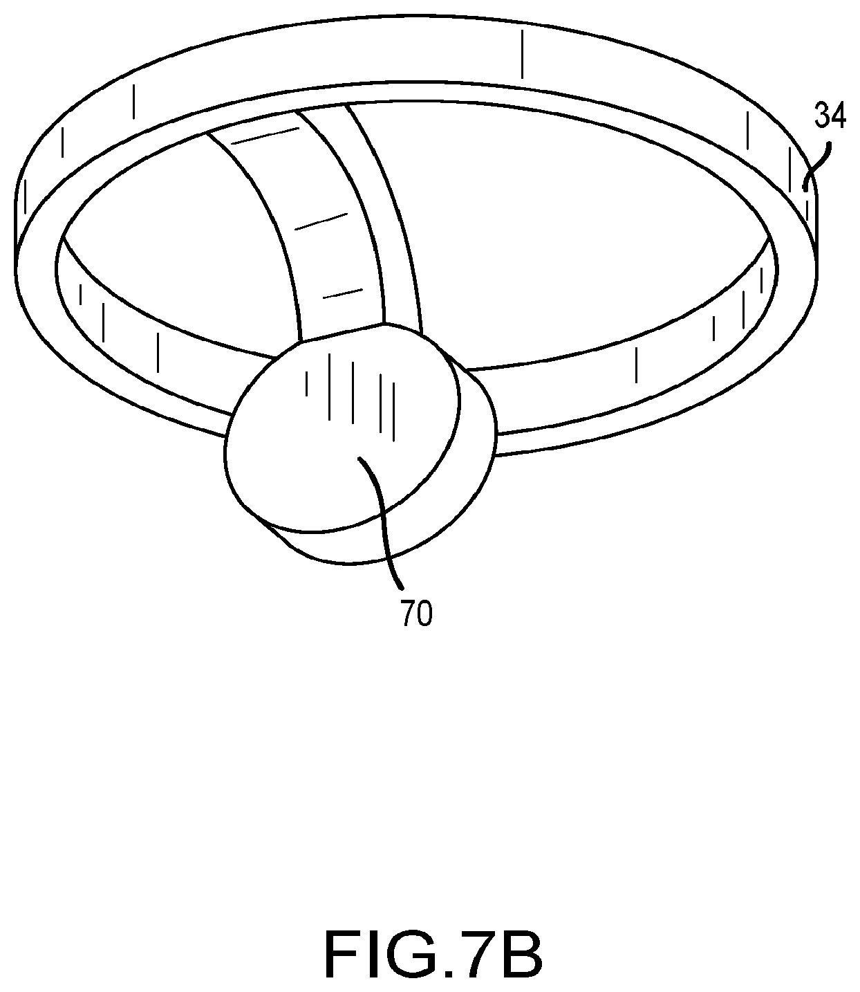 Patent US12096977 Figure 11 – Electrophysiology catheter with modular electrode structure