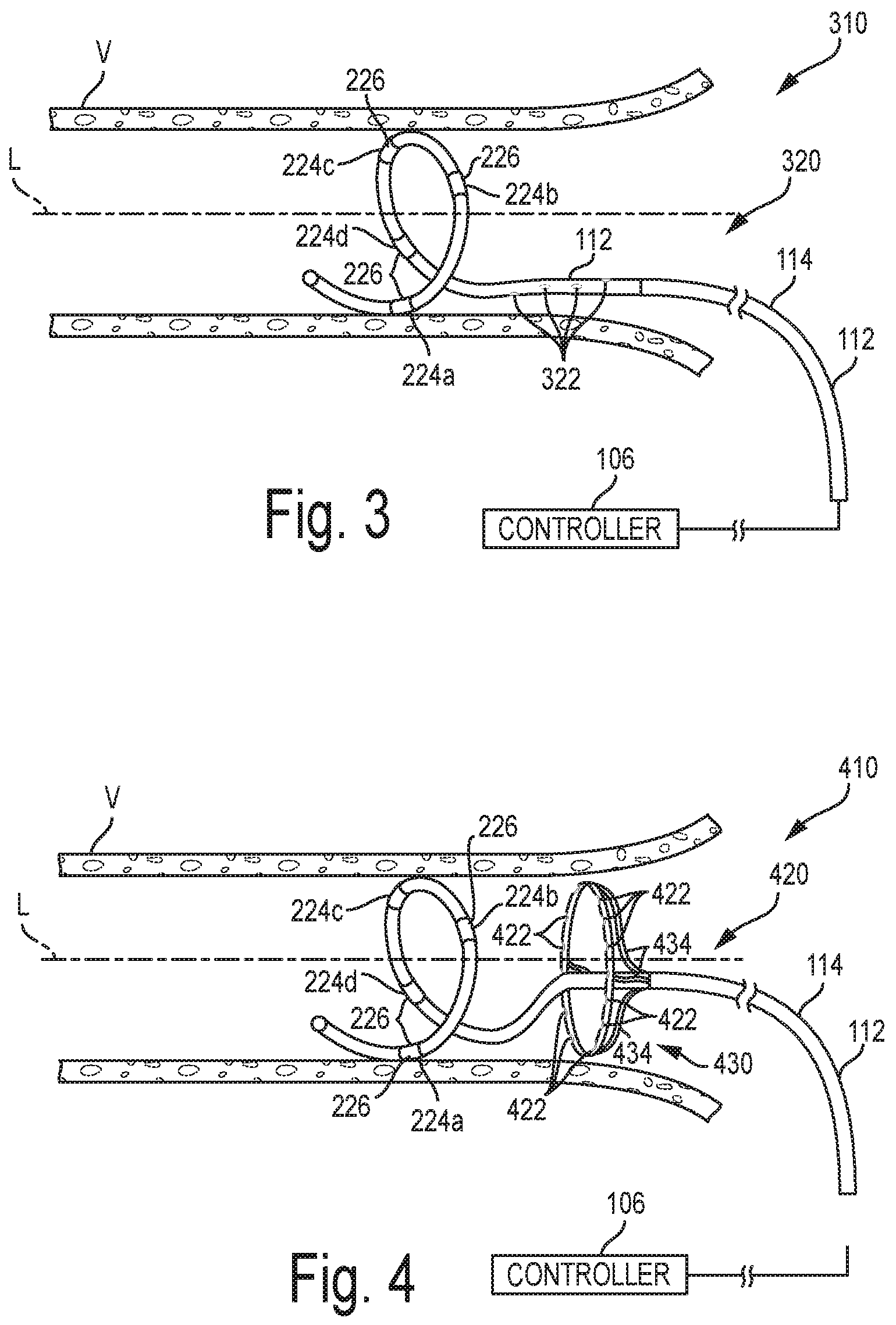 Patent US12096978 Figure 4 – Controlled irrigation for neuromodulation systems and associated methods