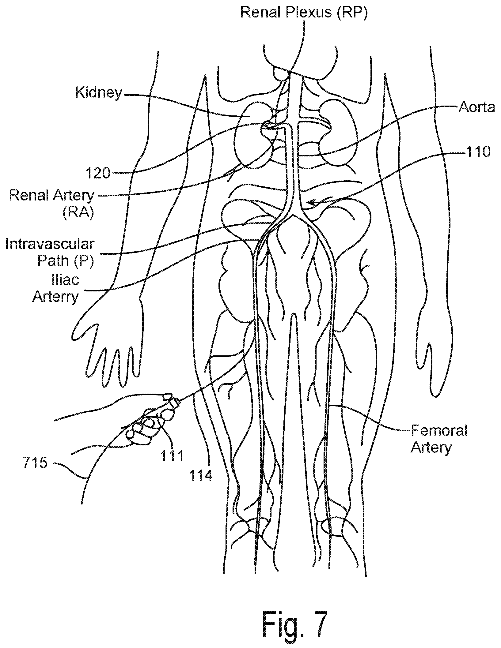 Patent US12096978 Figure 7 – Controlled irrigation for neuromodulation systems and associated methods