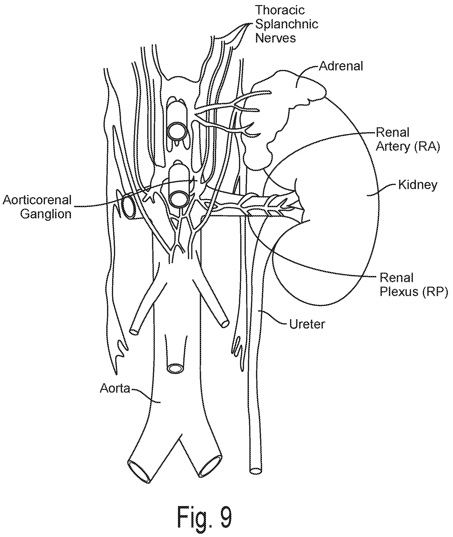 Patent US12096978 Figure 9 – Controlled irrigation for neuromodulation systems and associated methods