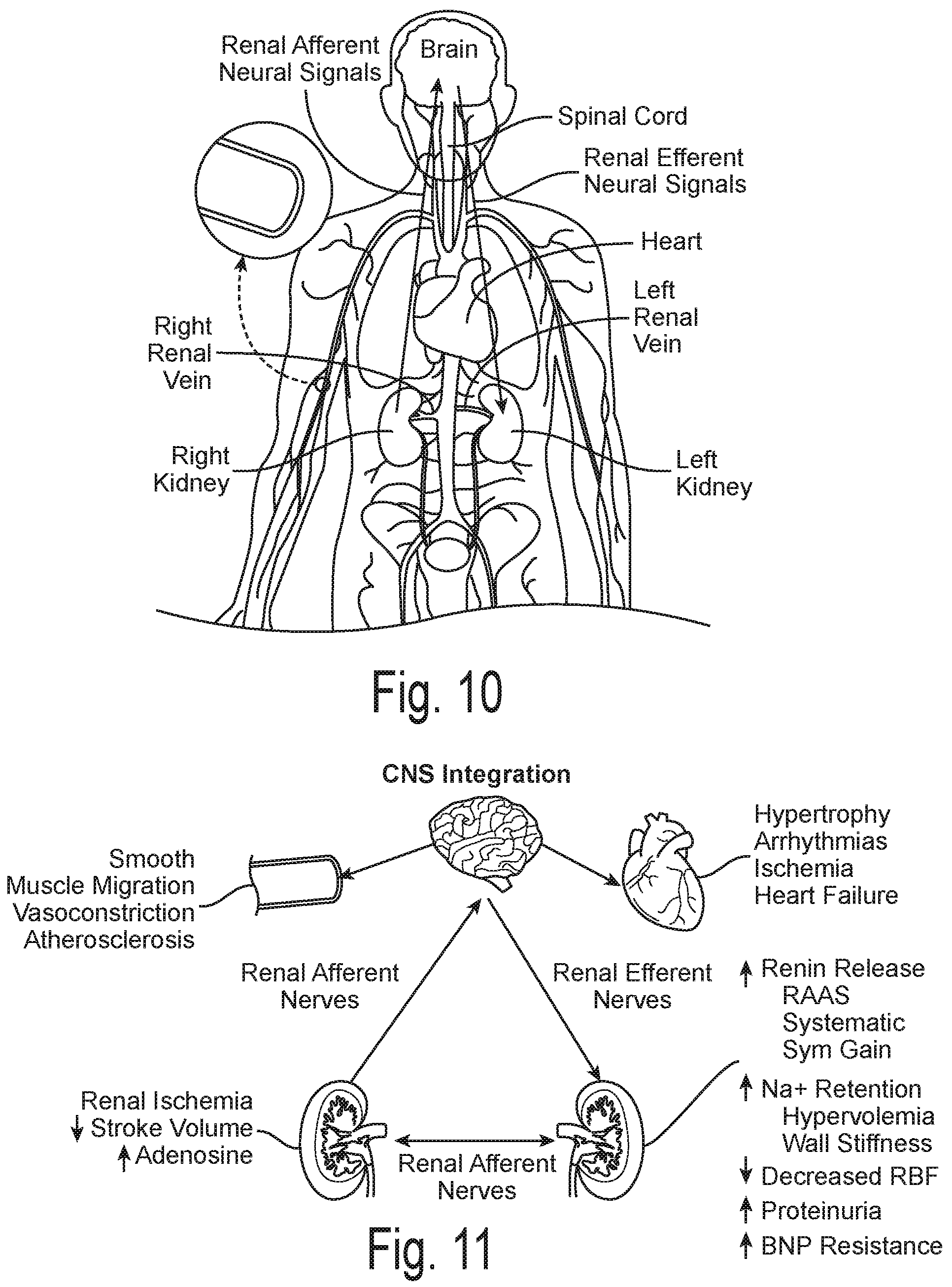 Patent US12096978 Figure 10 – Controlled irrigation for neuromodulation systems and associated methods