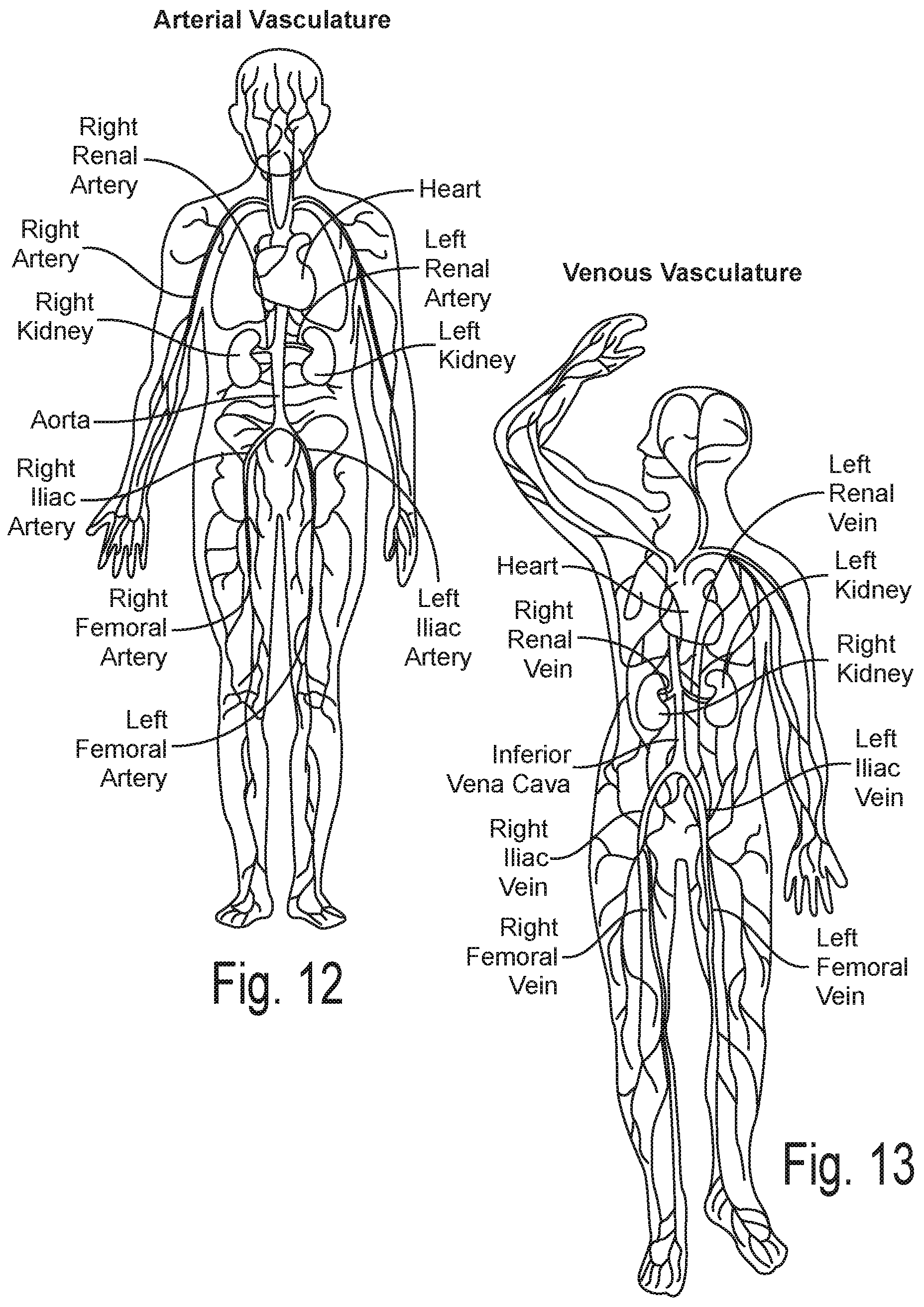 Patent US12096978 Figure 11 – Controlled irrigation for neuromodulation systems and associated methods