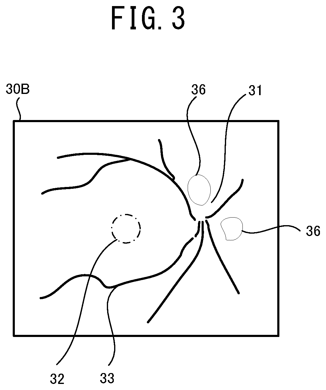 Patent US12096981 Figure 3 – Ophthalmologic image processing device and non-transitory computer-readable storage medium storing computer-readable instructions