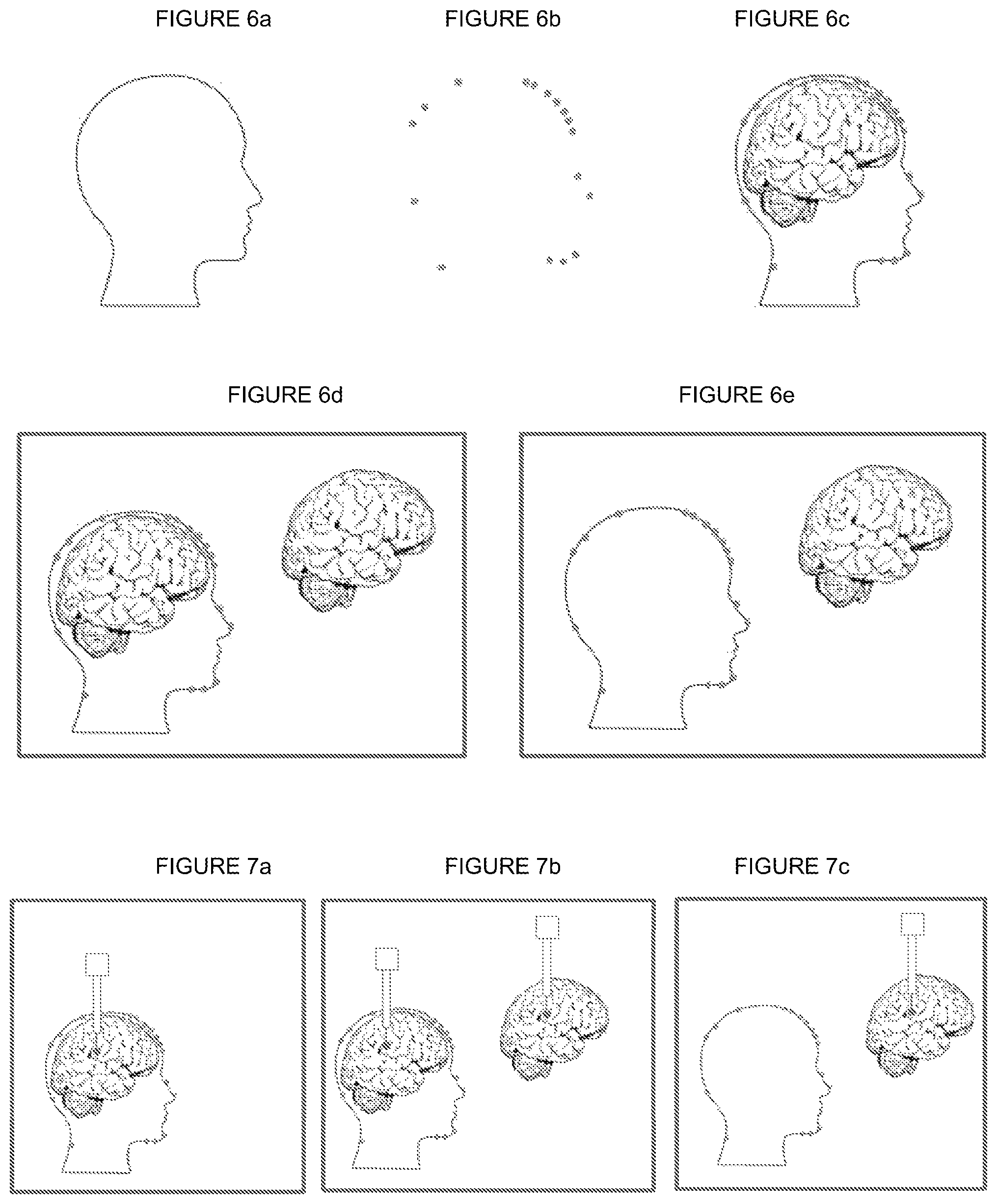 Patent US12096987 Figure 5 – Method and assembly for spatial mapping of a model, such as a holographic model, of a surgical tool and/or anatomical structure onto a spatial position of the surgical tool respectively anatomical structure, as well as a surgical tool