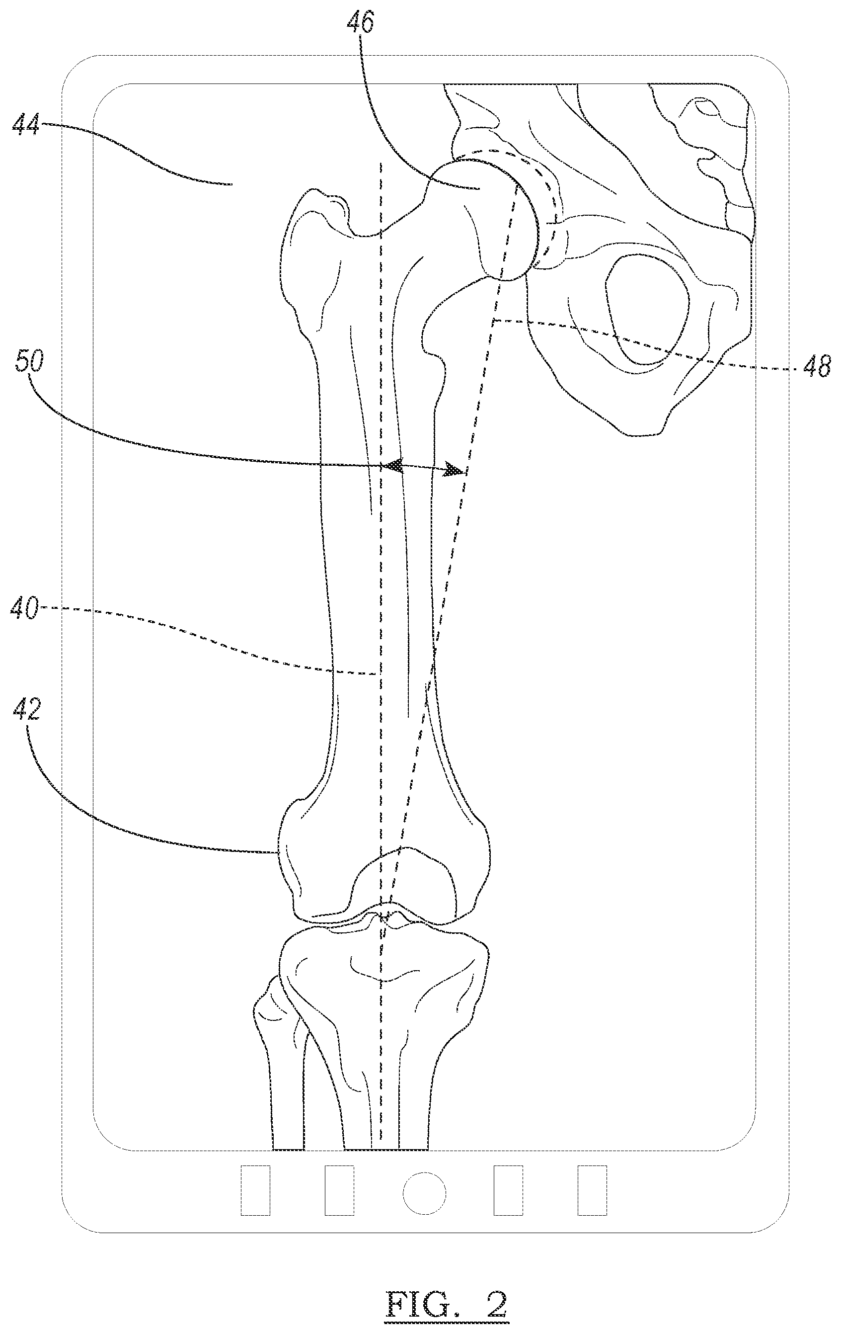 Patent US12096989 Figure 2 – Plan implementation