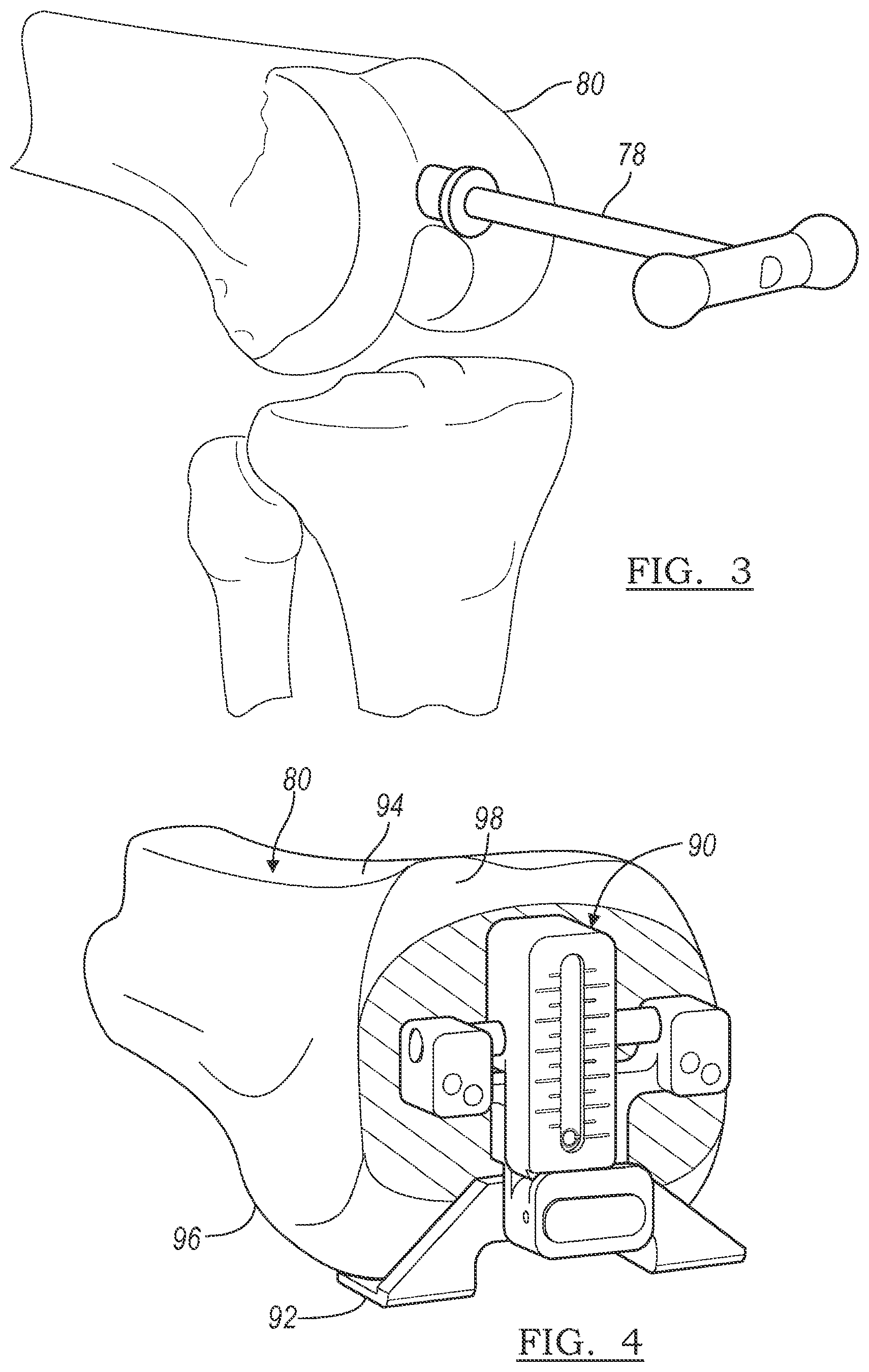 Patent US12096989 Figure 3 – Plan implementation