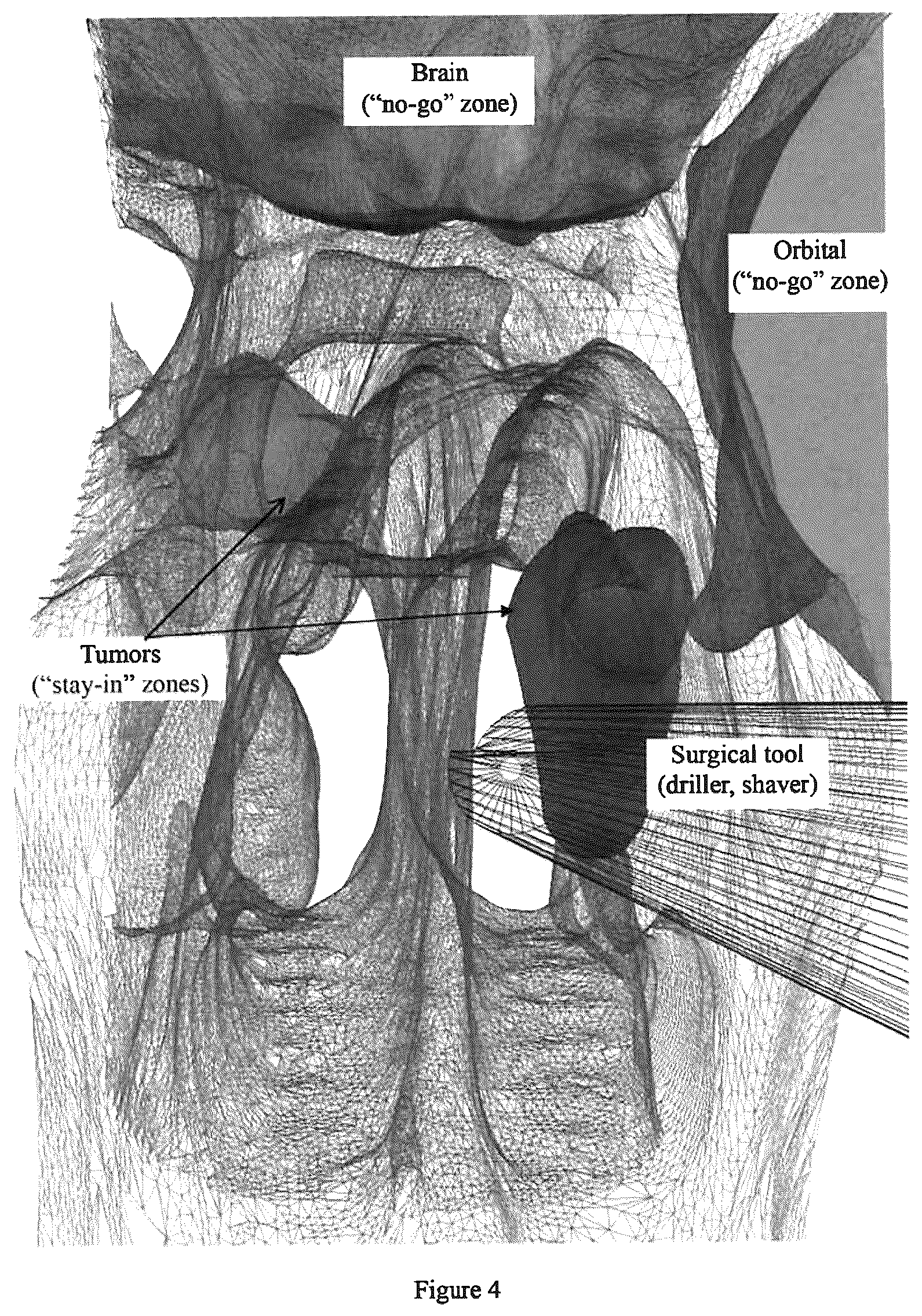 Patent US12096994 Figure 5 – Robotic system and method for spinal and other surgeries