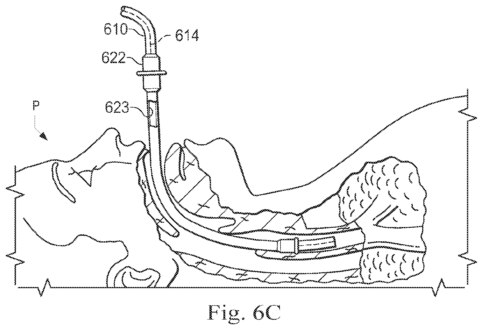 Patent US12096996 Figure 6 – Systems and methods of registration for image-guided procedures