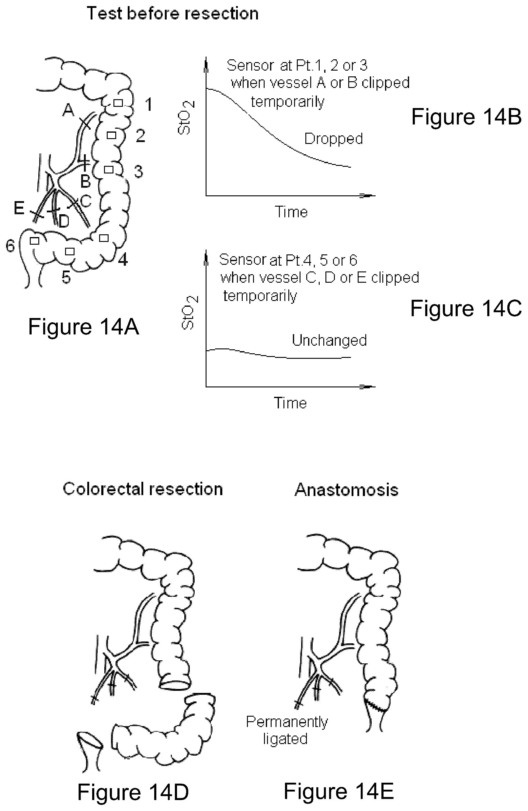 Patent US12097008 Figure 14 – Using an oximeter probe to detect intestinal ischemia