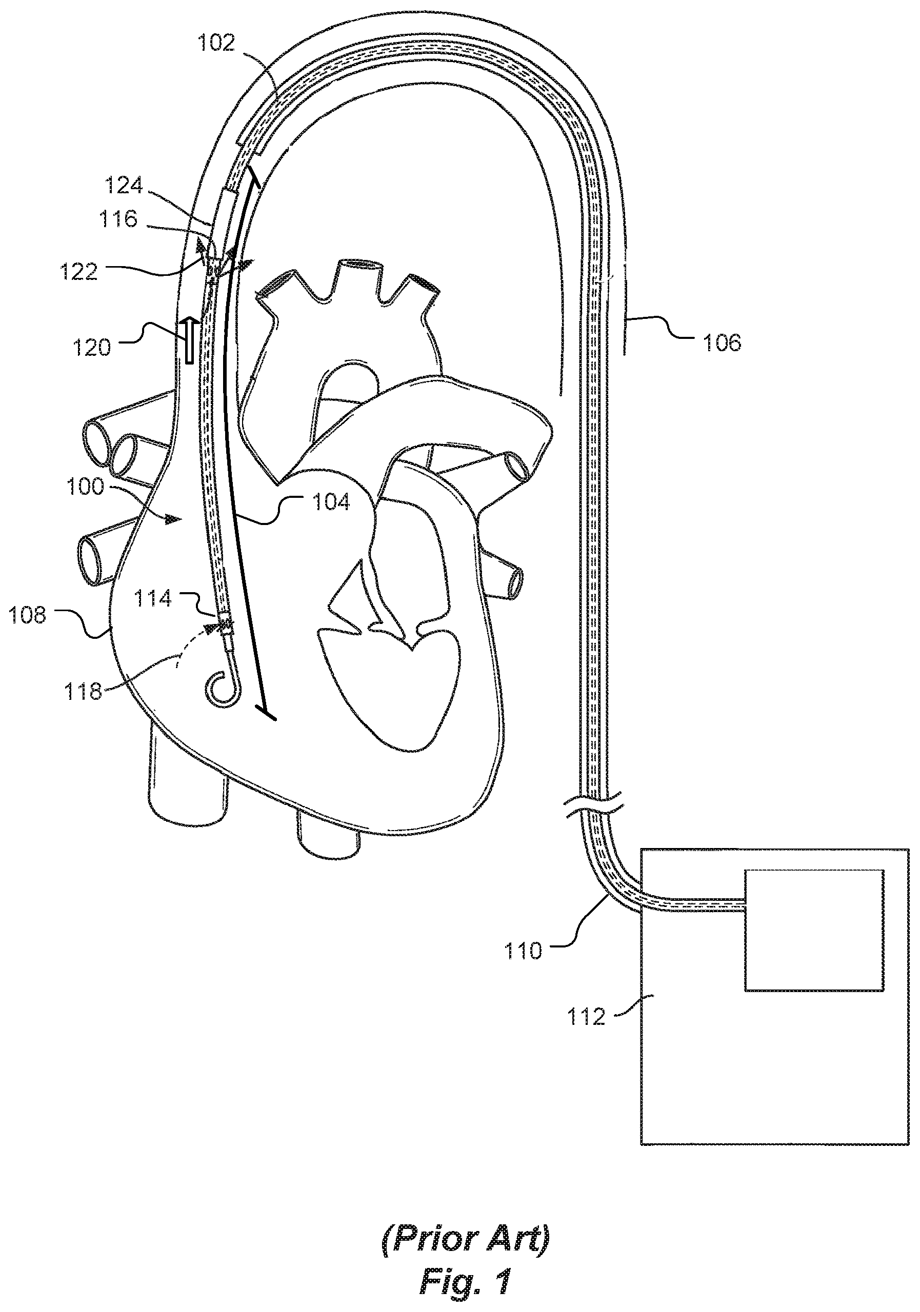 Patent US12097016 Figure 1 – Blood flow rate measurement system