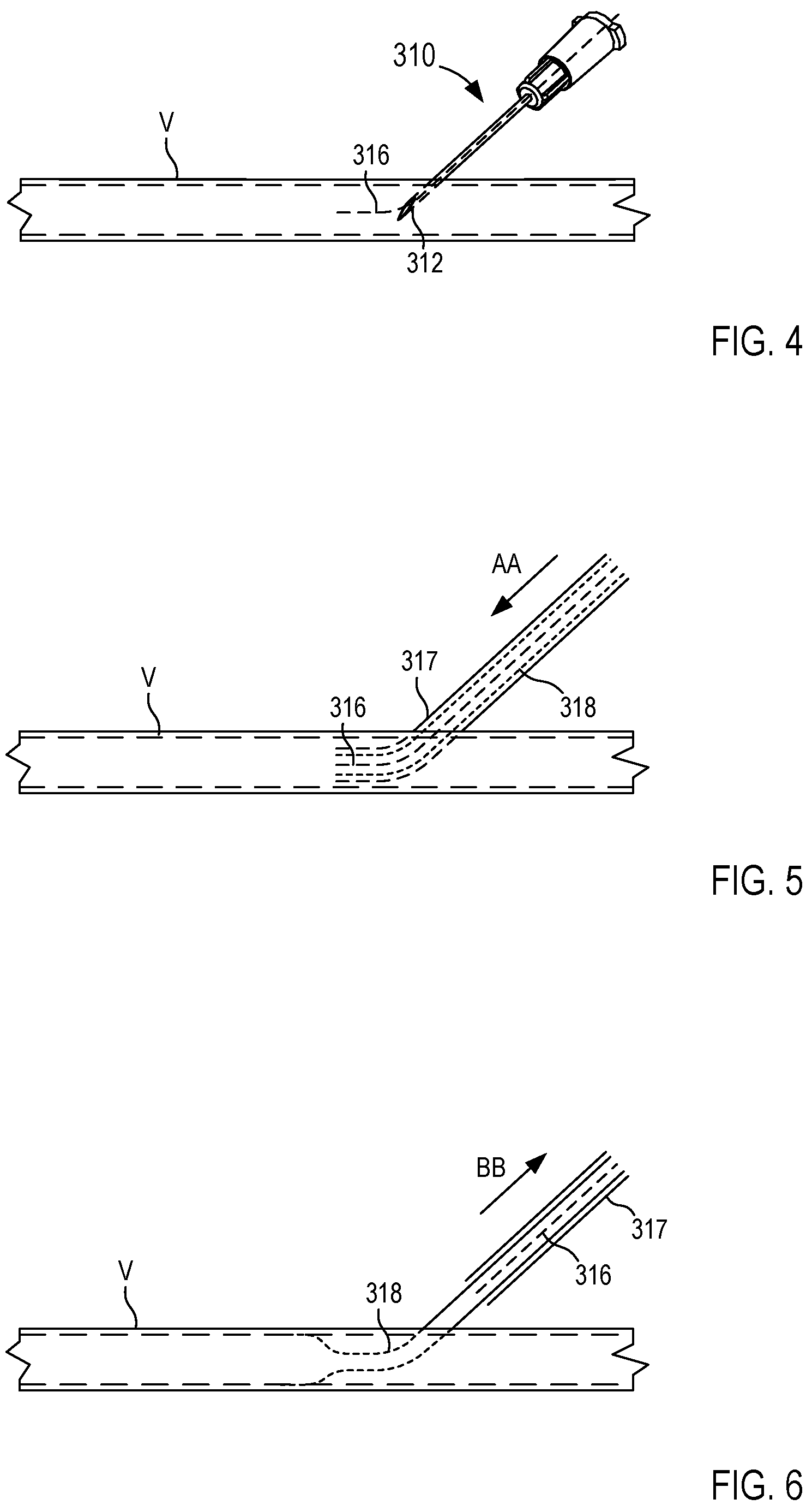 Patent US12097027 Figure 3 – Systems and methods for sample collection with reduced hemolysis