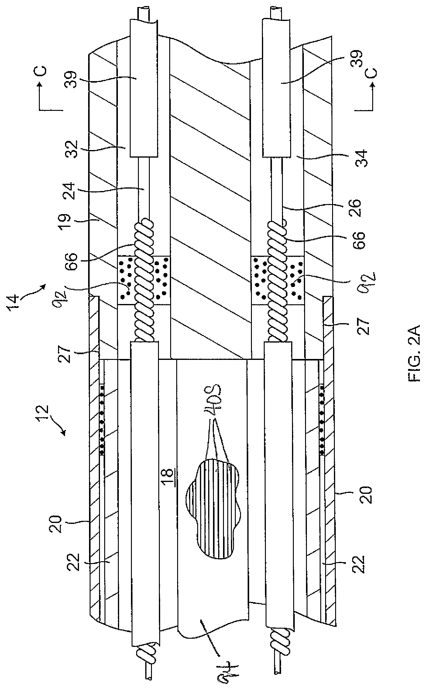 Patent US12097034 Figure 2 – Catheter with stacked spine electrode assembly