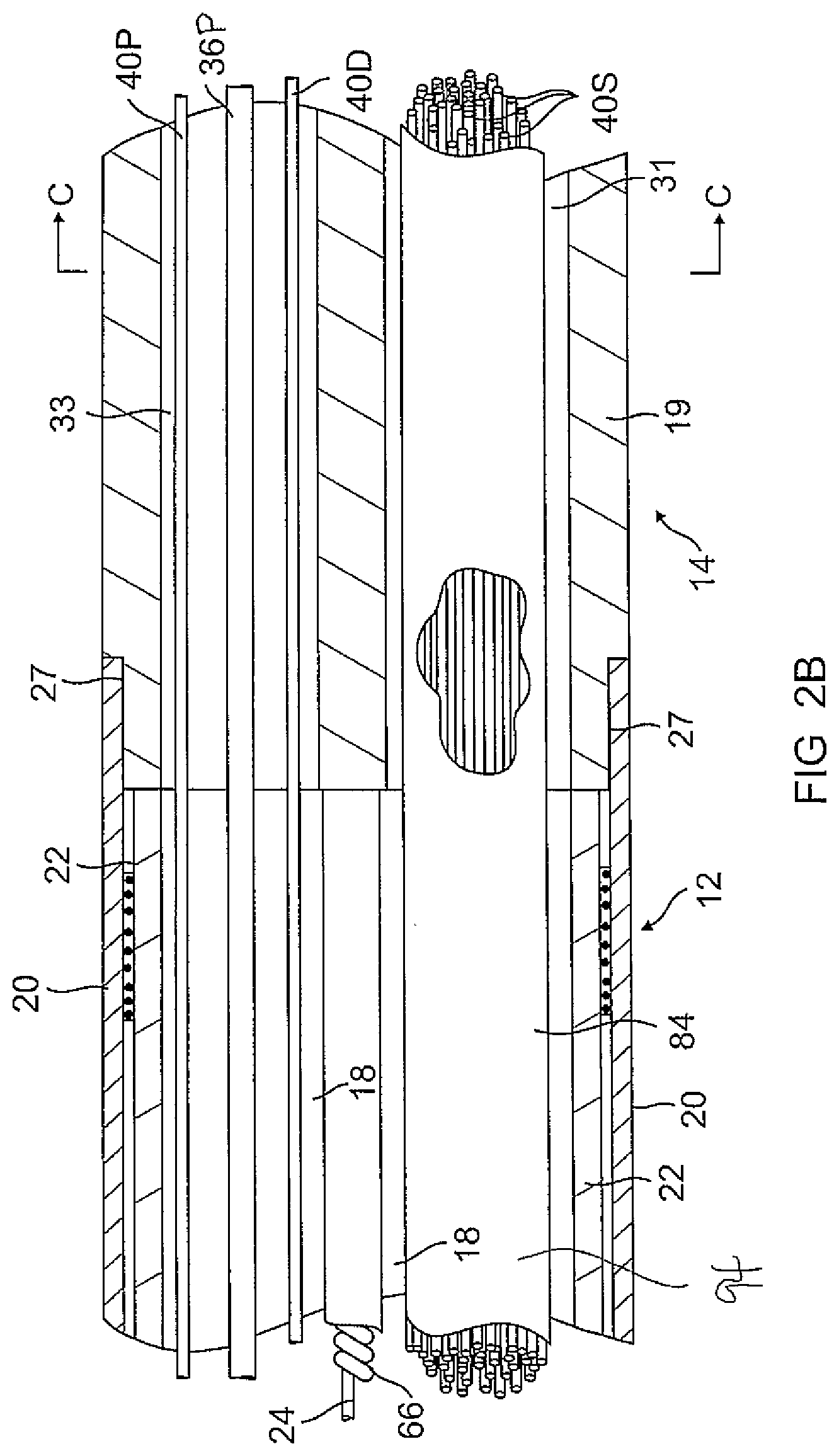 Patent US12097034 Figure 3 – Catheter with stacked spine electrode assembly