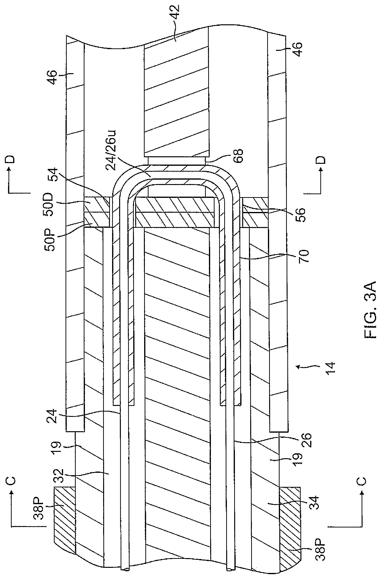Patent US12097034 Figure 5 – Catheter with stacked spine electrode assembly
