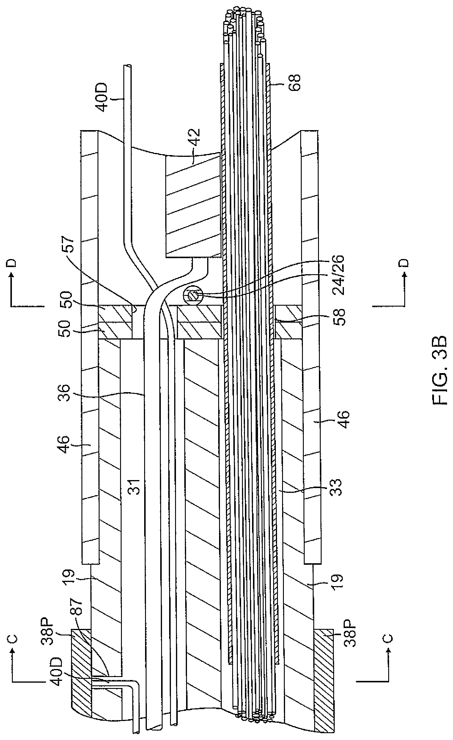 Patent US12097034 Figure 6 – Catheter with stacked spine electrode assembly