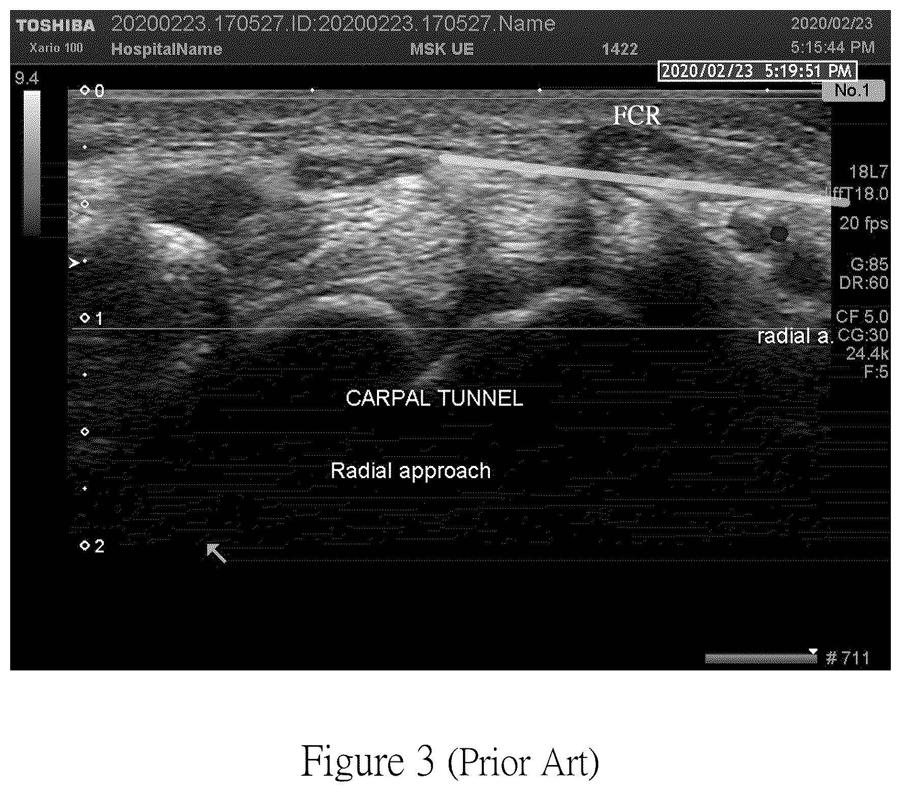 Patent US12097042 Figure 3 – Method for detecting carpal tunnel using an ultrasonic detection device