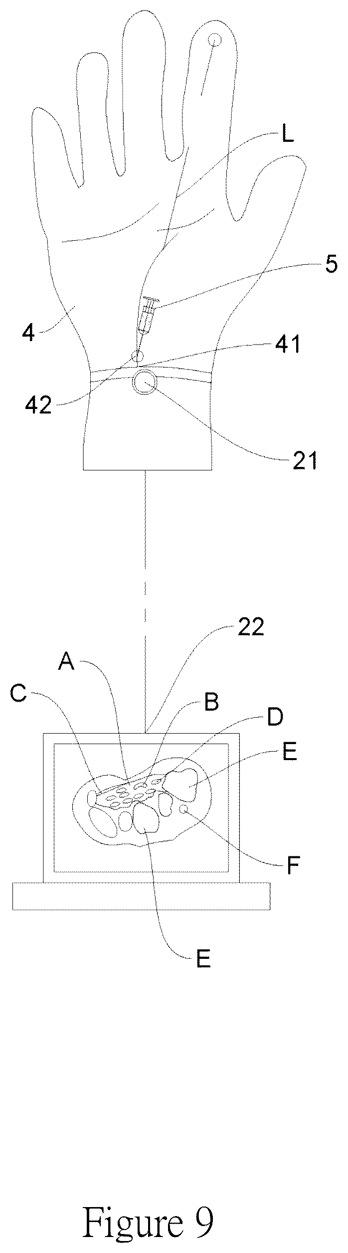 Patent US12097042 Figure 9 – Method for detecting carpal tunnel using an ultrasonic detection device