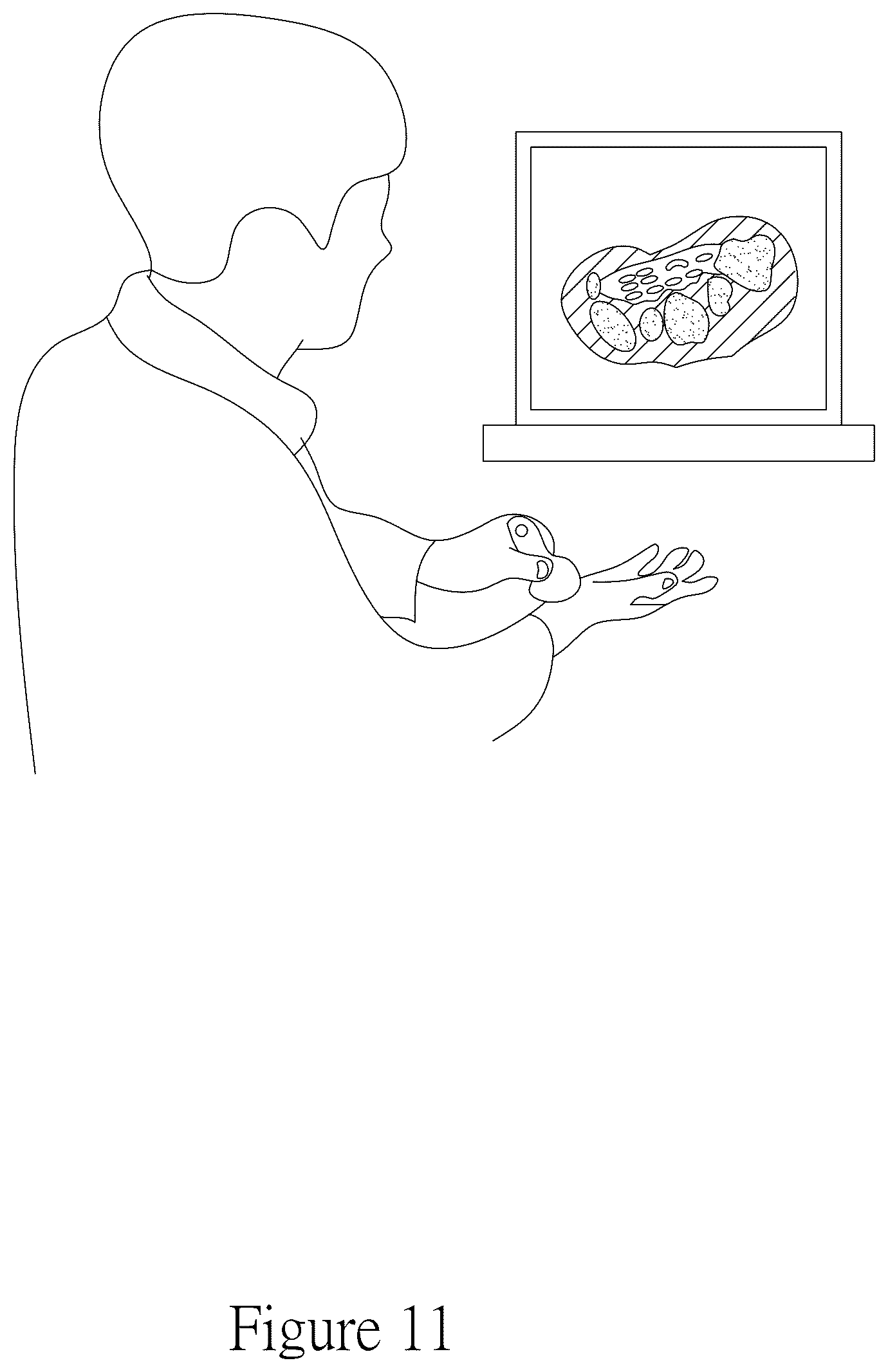 Patent US12097042 Figure 11 – Method for detecting carpal tunnel using an ultrasonic detection device